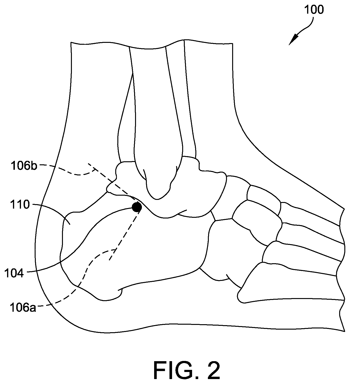 Patent US12310799 Figure 2 – Minimally invasive surgery laser guide