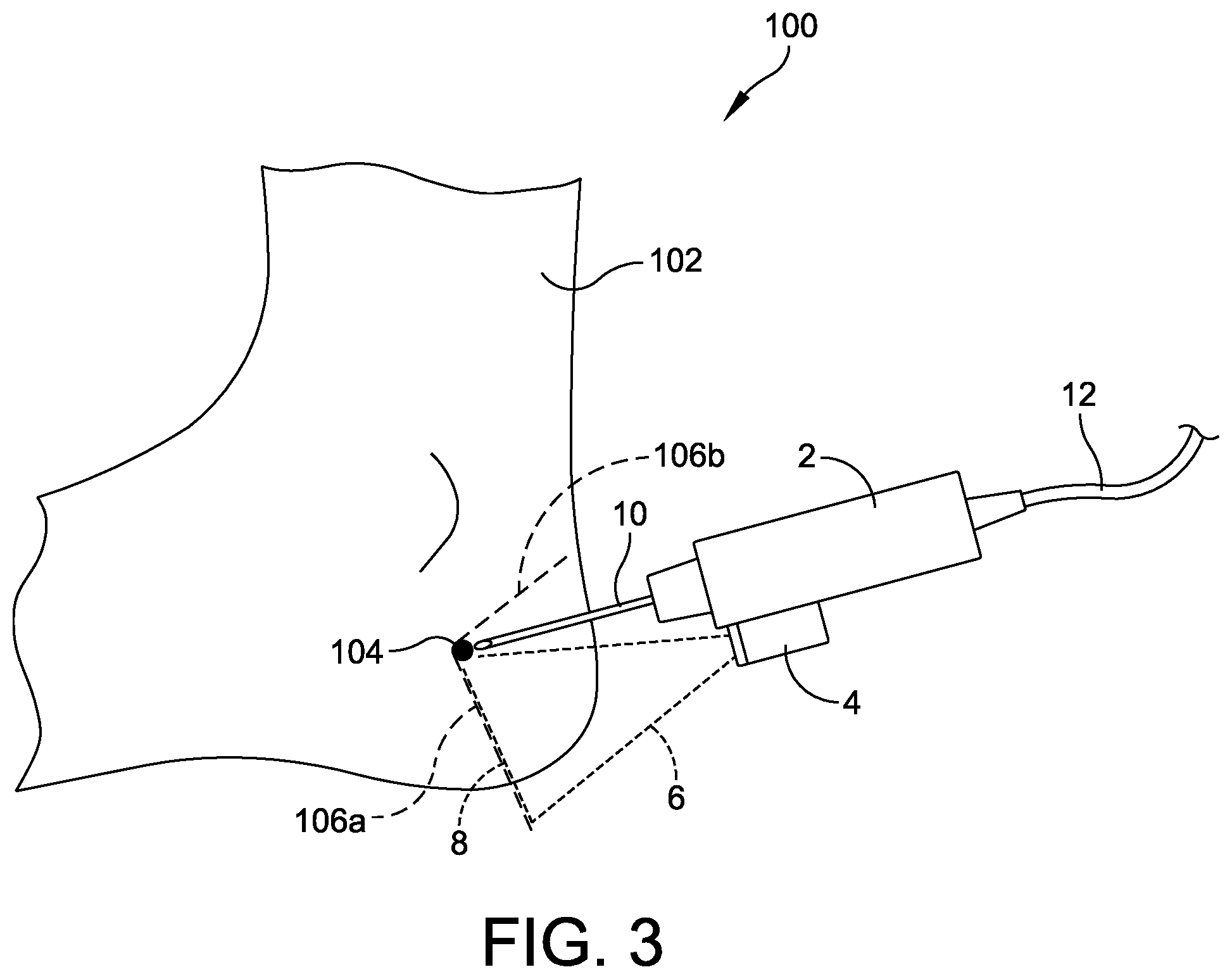 Patent US12310799 Figure 3 – Minimally invasive surgery laser guide
