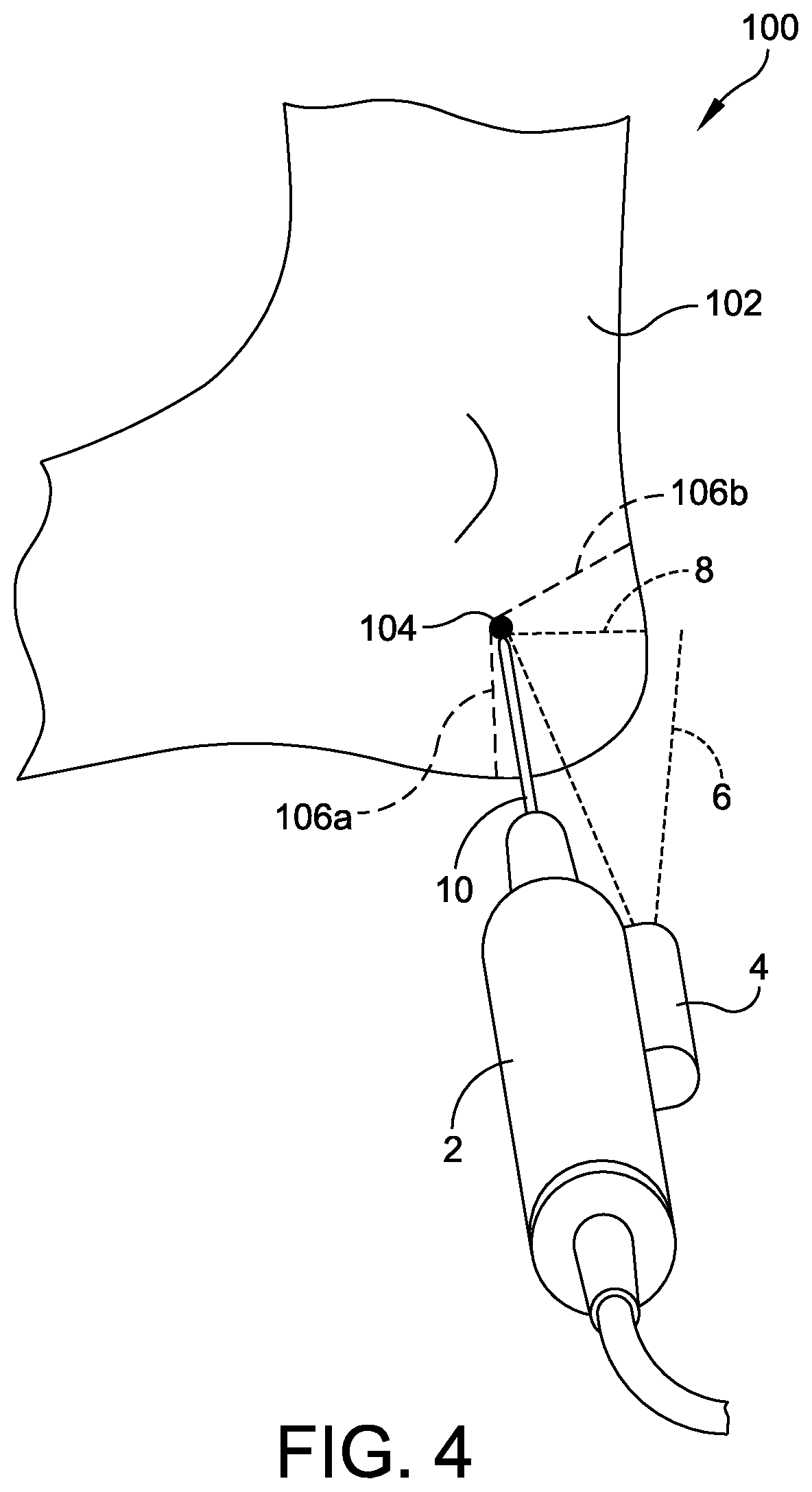 Patent US12310799 Figure 4 – Minimally invasive surgery laser guide