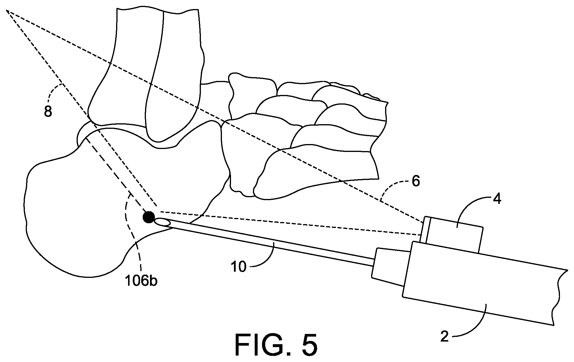 Patent US12310799 Figure 5 – Minimally invasive surgery laser guide