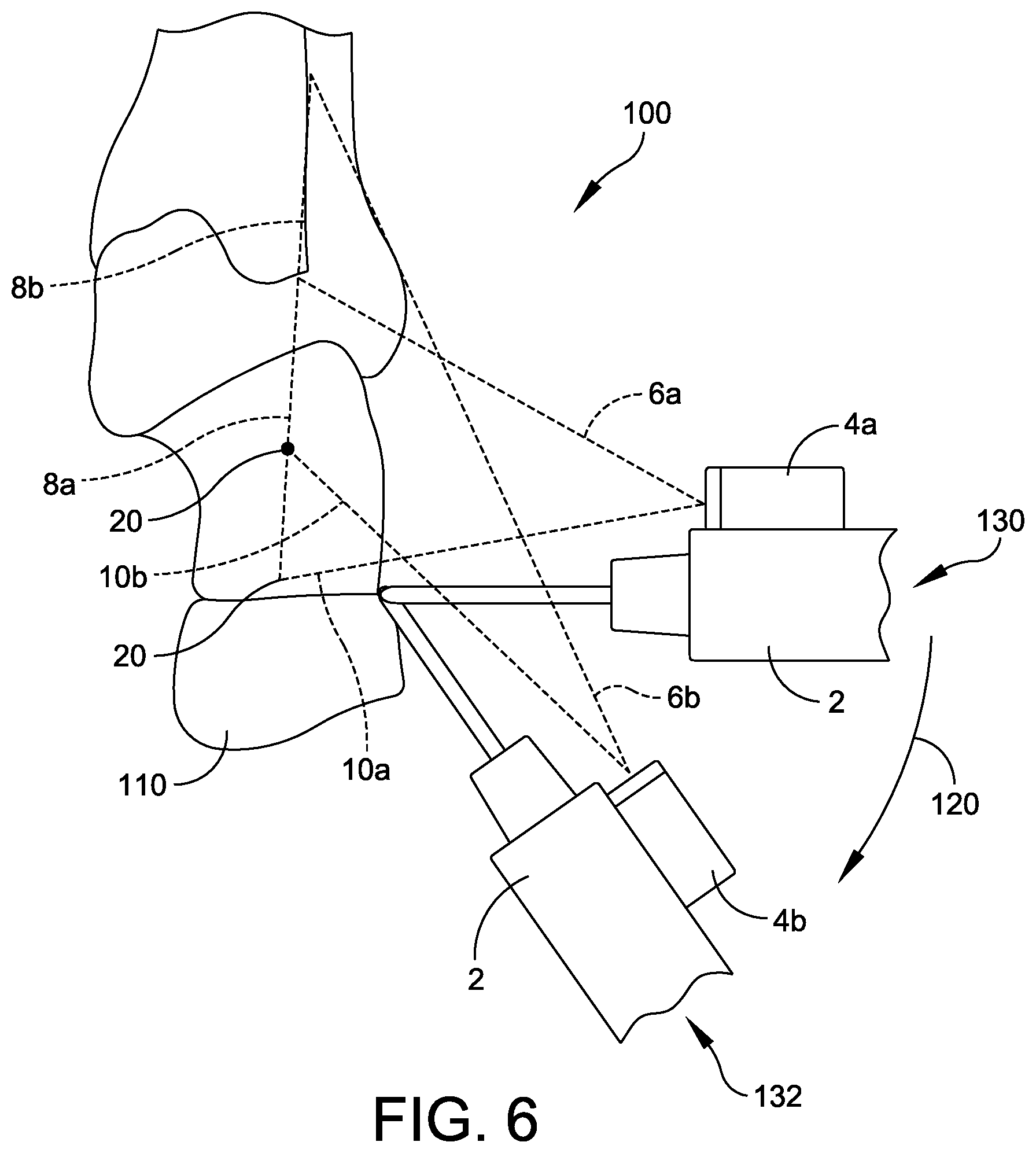 Patent US12310799 Figure 6 – Minimally invasive surgery laser guide