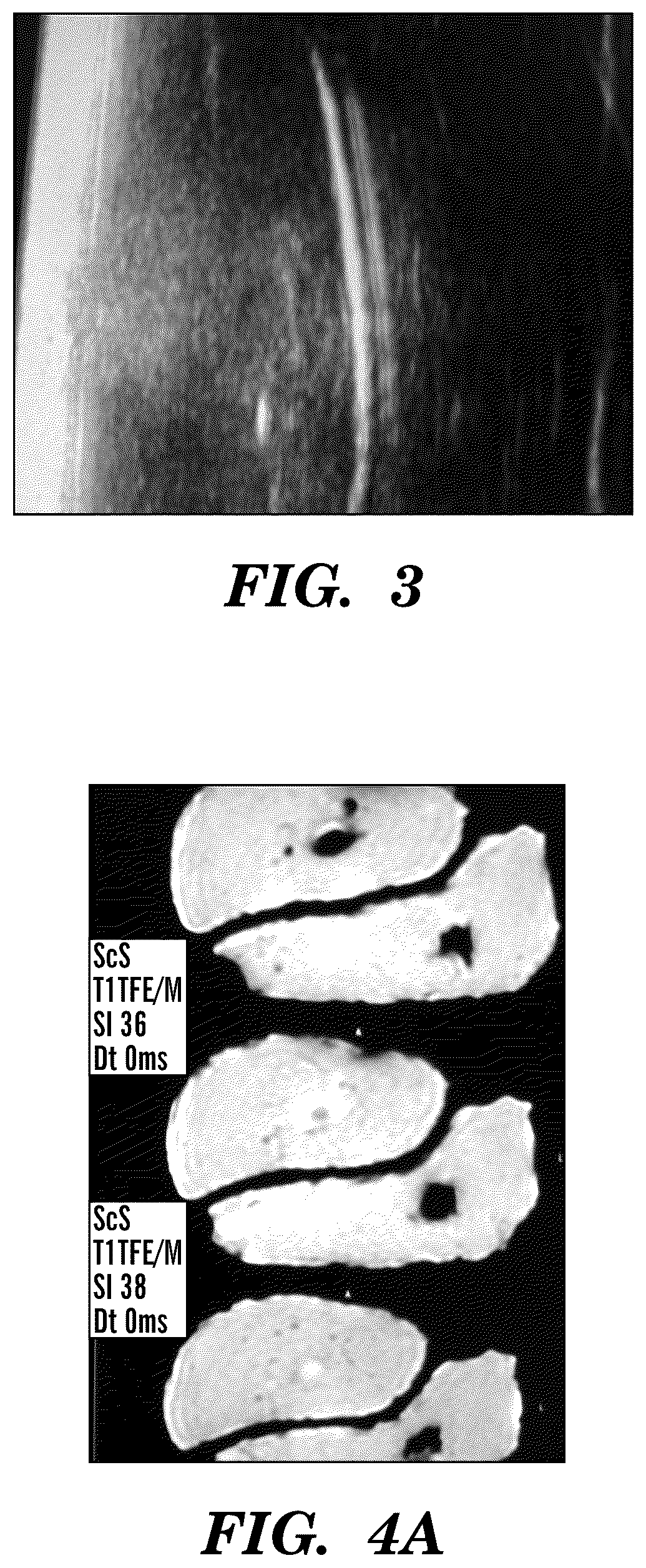 Patent US12310800 Figure 4 – Injection applicator for tissue markers