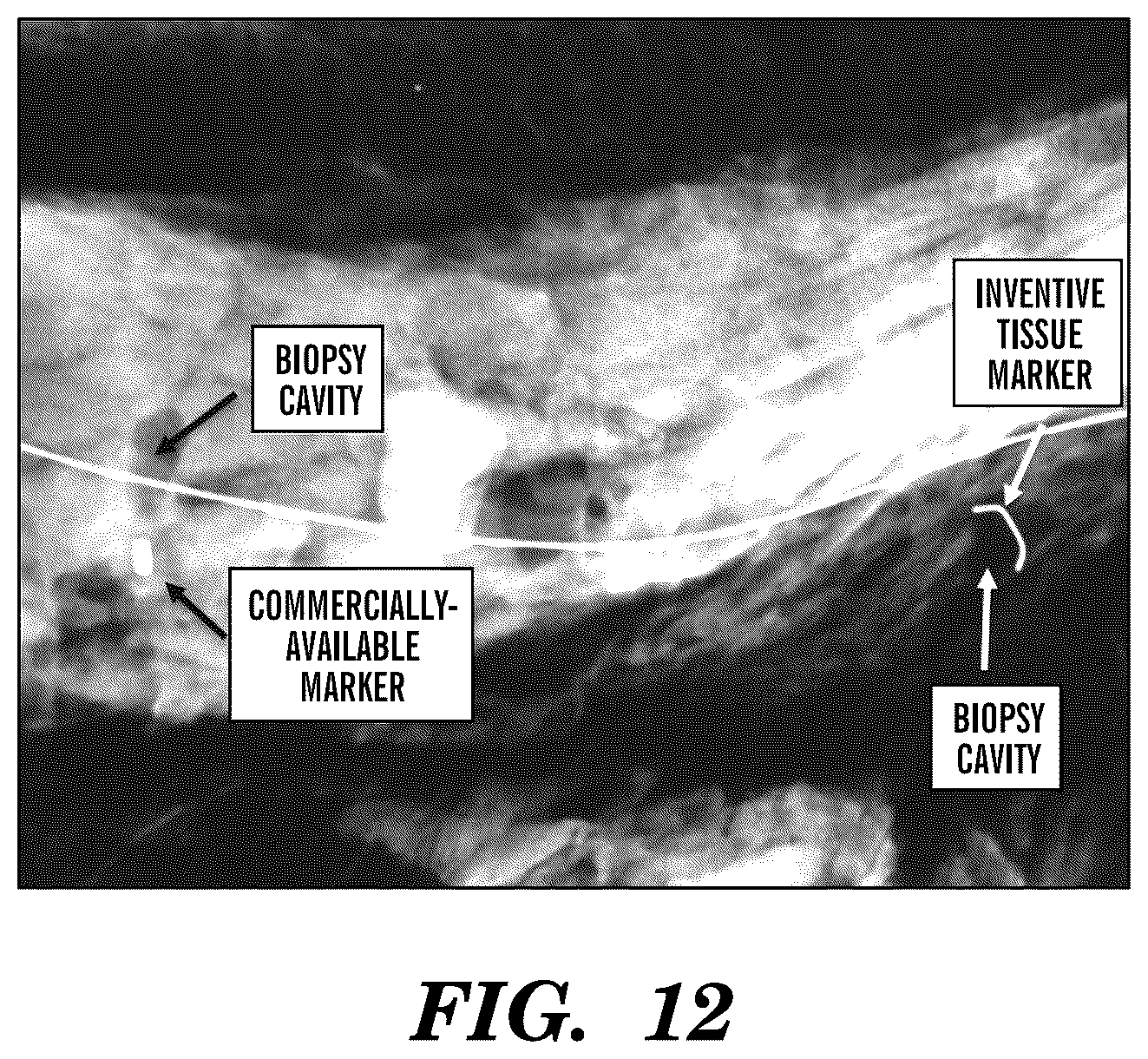 Patent US12310800 Figure 11 – Injection applicator for tissue markers