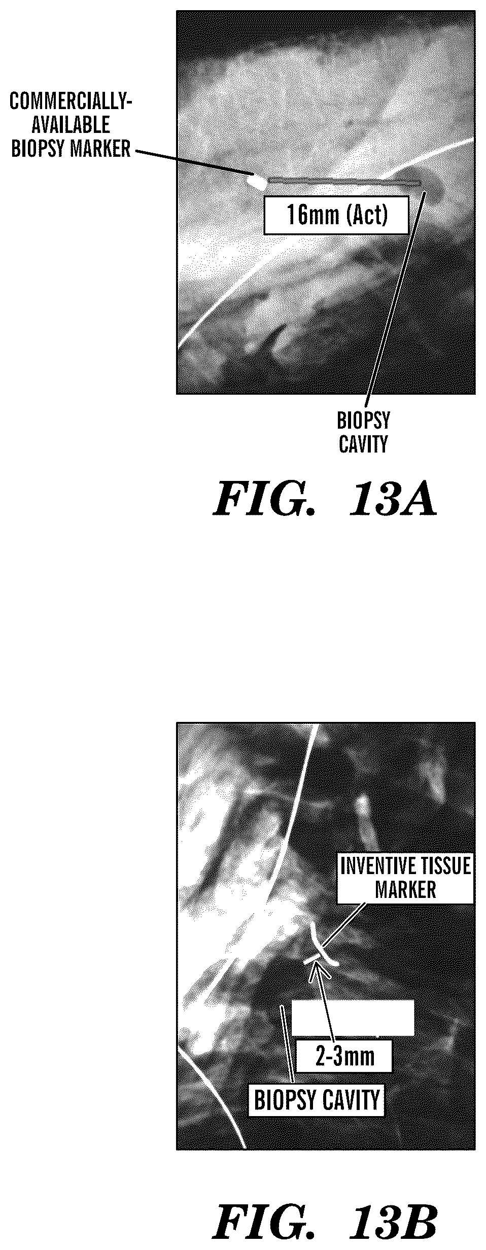 Patent US12310800 Figure 12 – Injection applicator for tissue markers