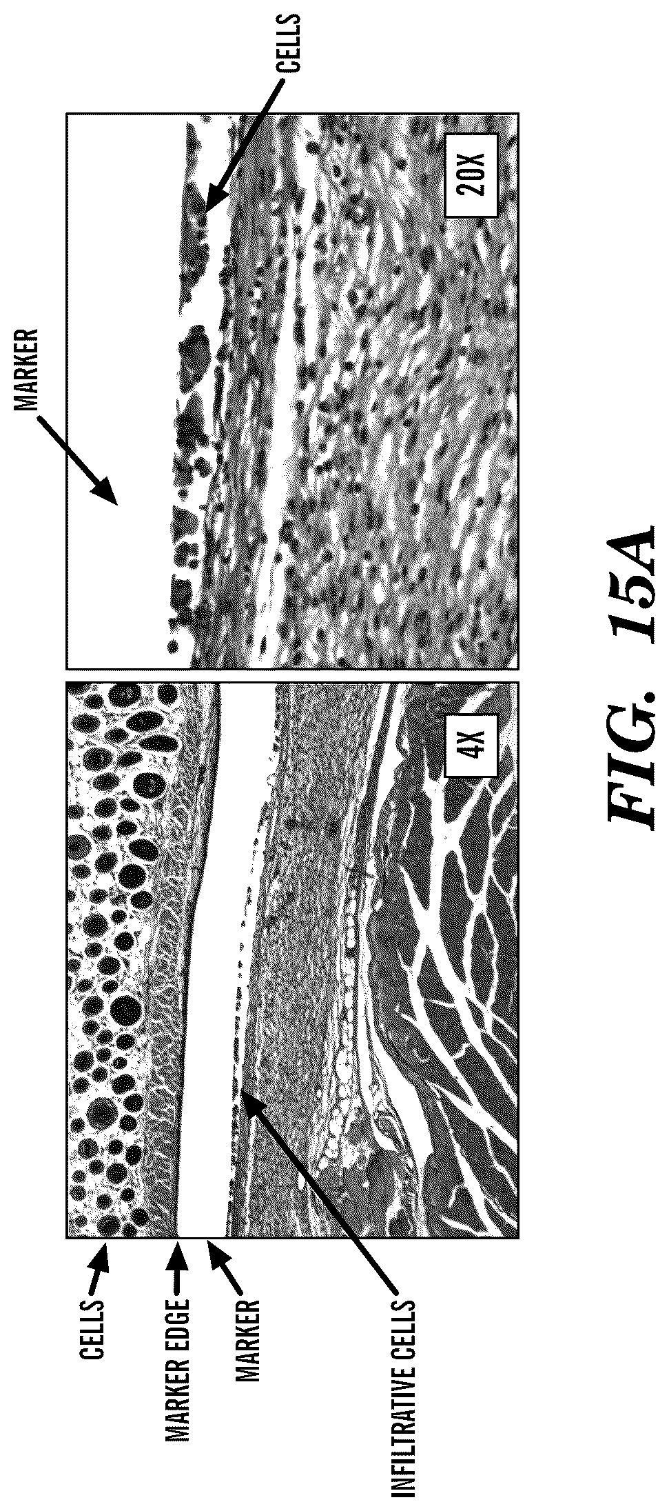 Patent US12310800 Figure 15 – Injection applicator for tissue markers