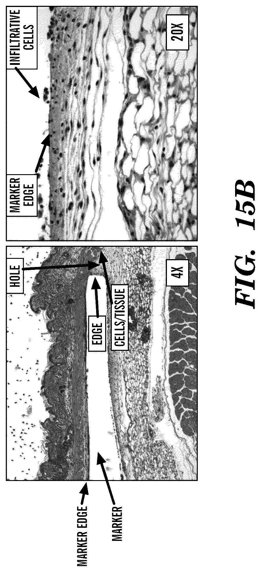 Patent US12310800 Figure 16 – Injection applicator for tissue markers