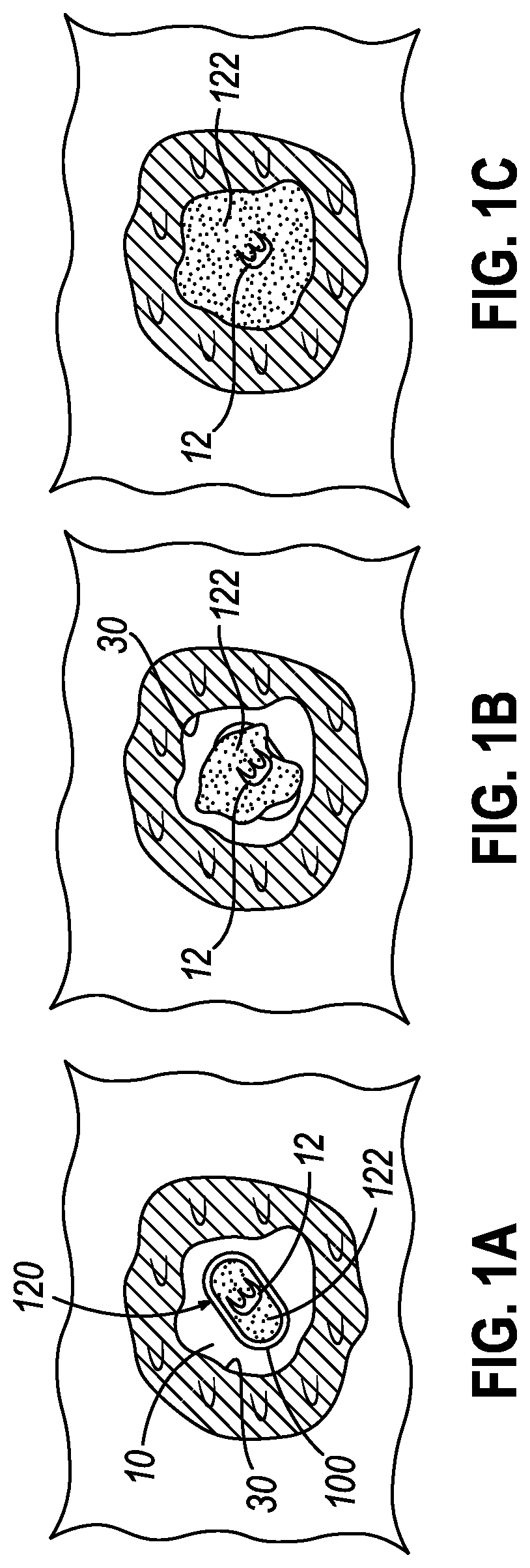 Patent US12310801 Figure 1 – Apparatus for delivering biopsy cavity marker