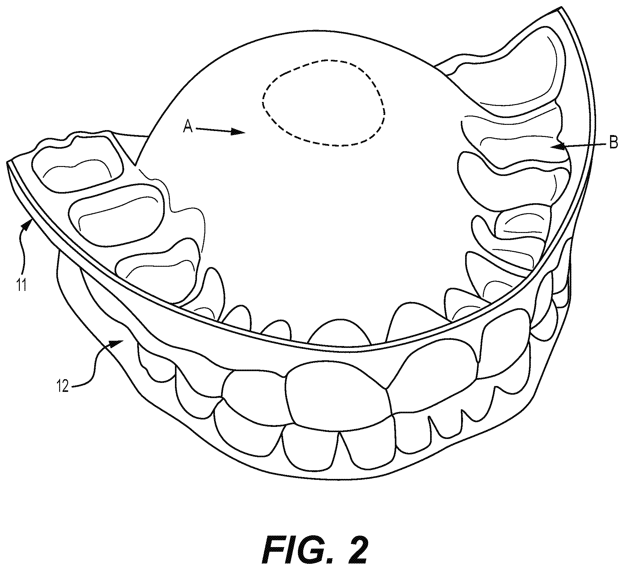 Patent US12310812 Figure 2 – Multifunctional oral appliance