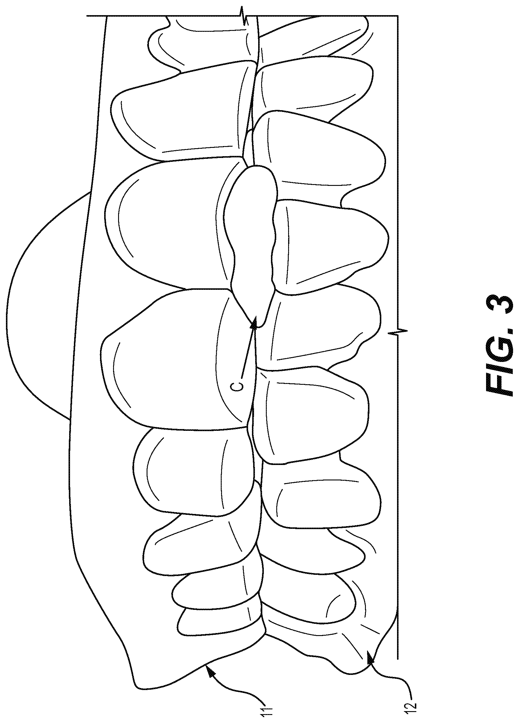 Patent US12310812 Figure 3 – Multifunctional oral appliance