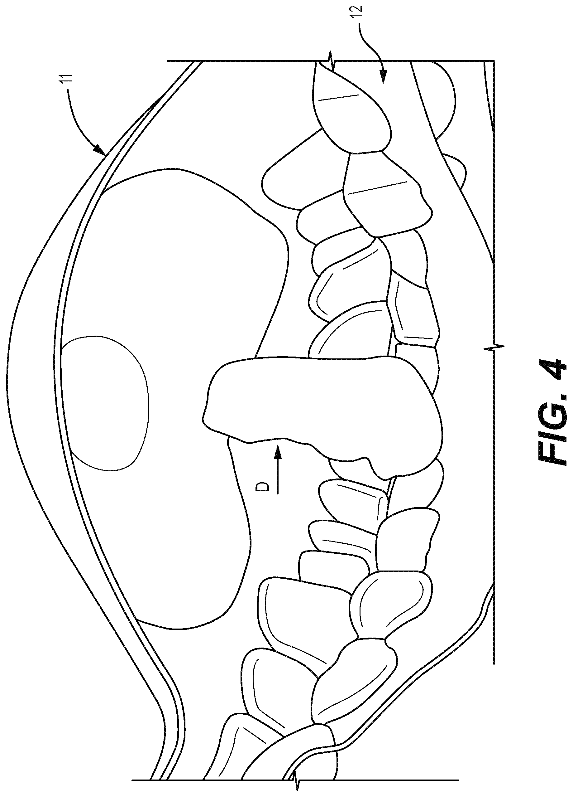 Patent US12310812 Figure 4 – Multifunctional oral appliance