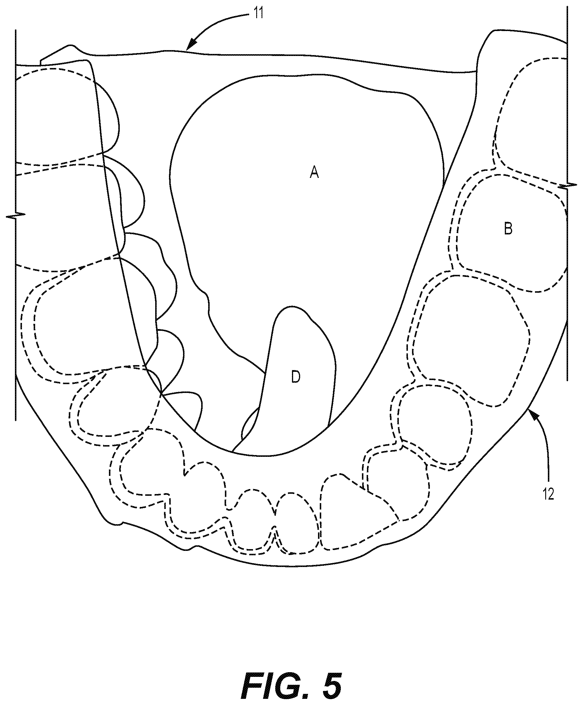Patent US12310812 Figure 5 – Multifunctional oral appliance