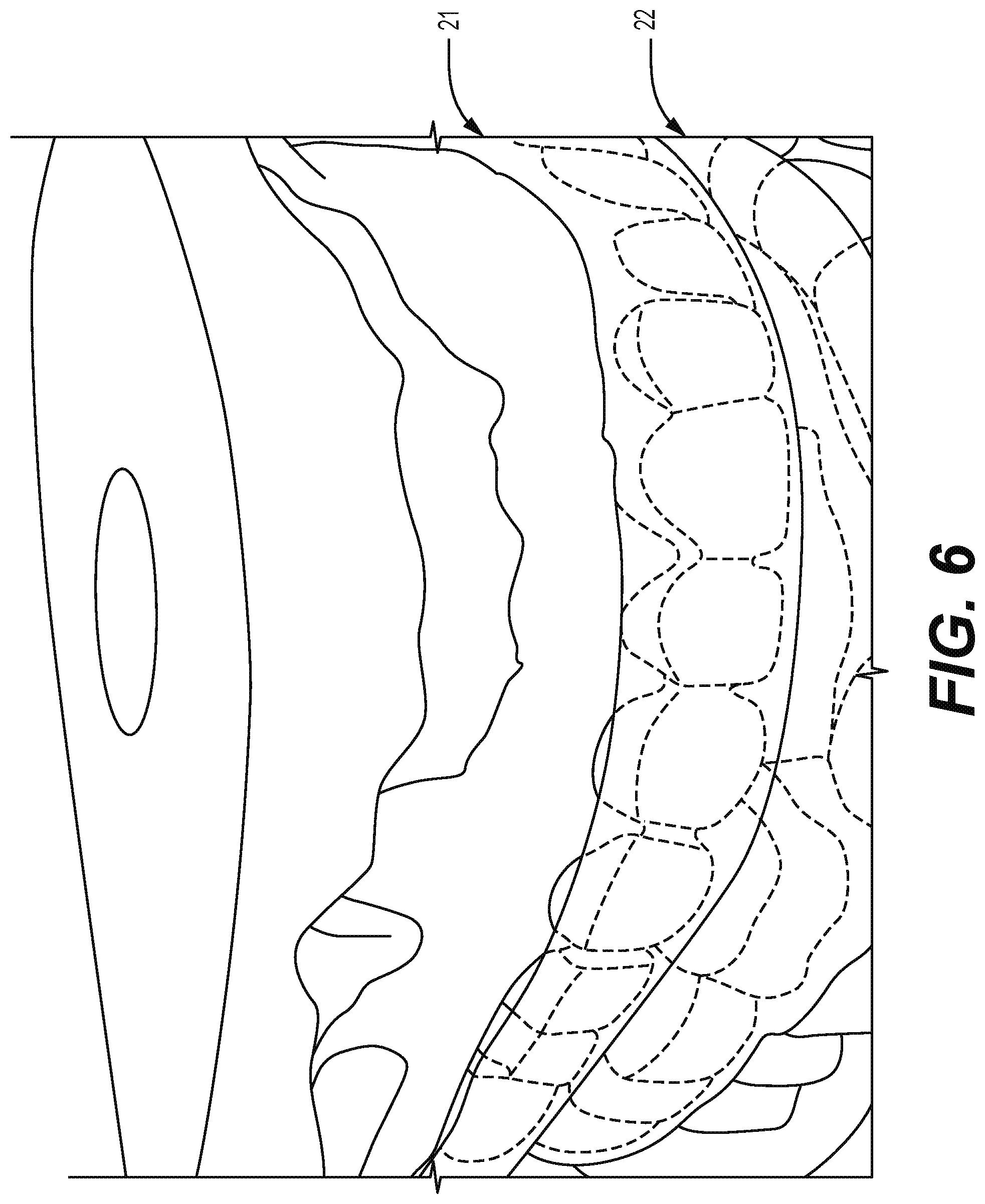 Patent US12310812 Figure 6 – Multifunctional oral appliance