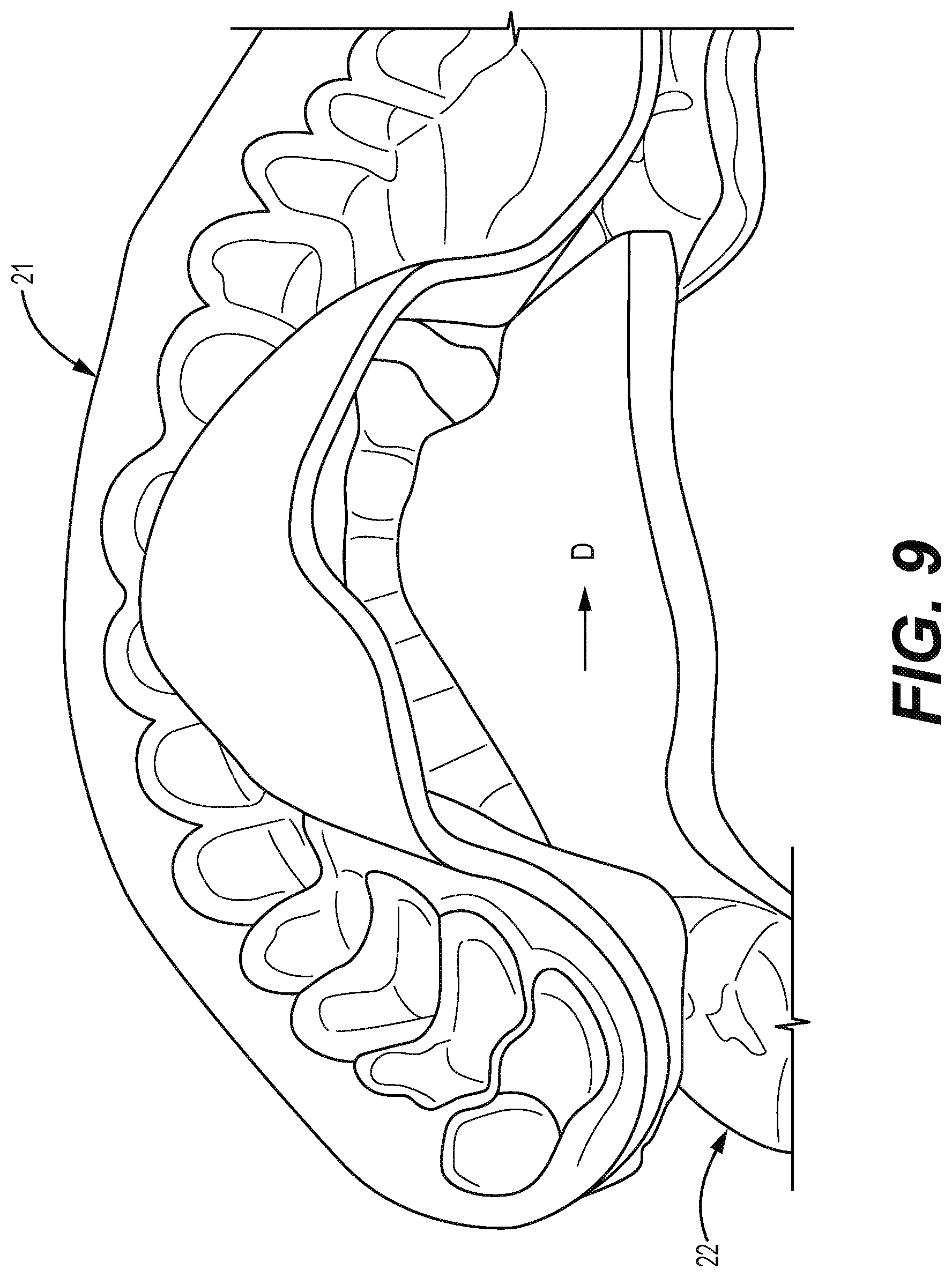 Patent US12310812 Figure 9 – Multifunctional oral appliance