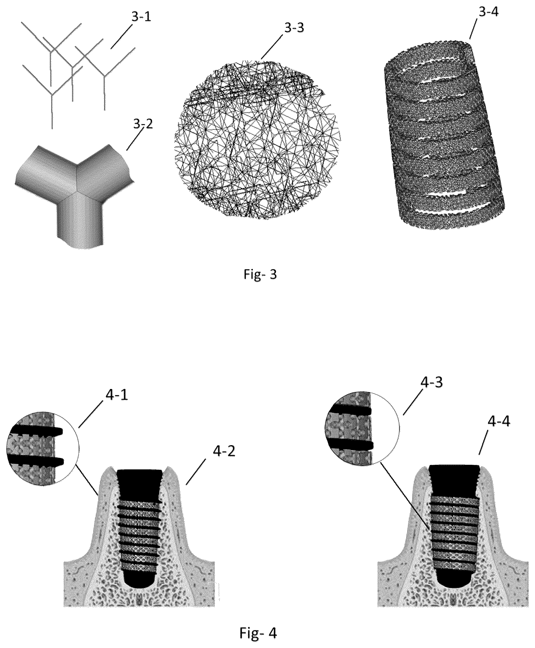 Patent US12310815 Figure 2 – Dental implant and self-locking fastening element with heterogeneousporous structures, and method for its production