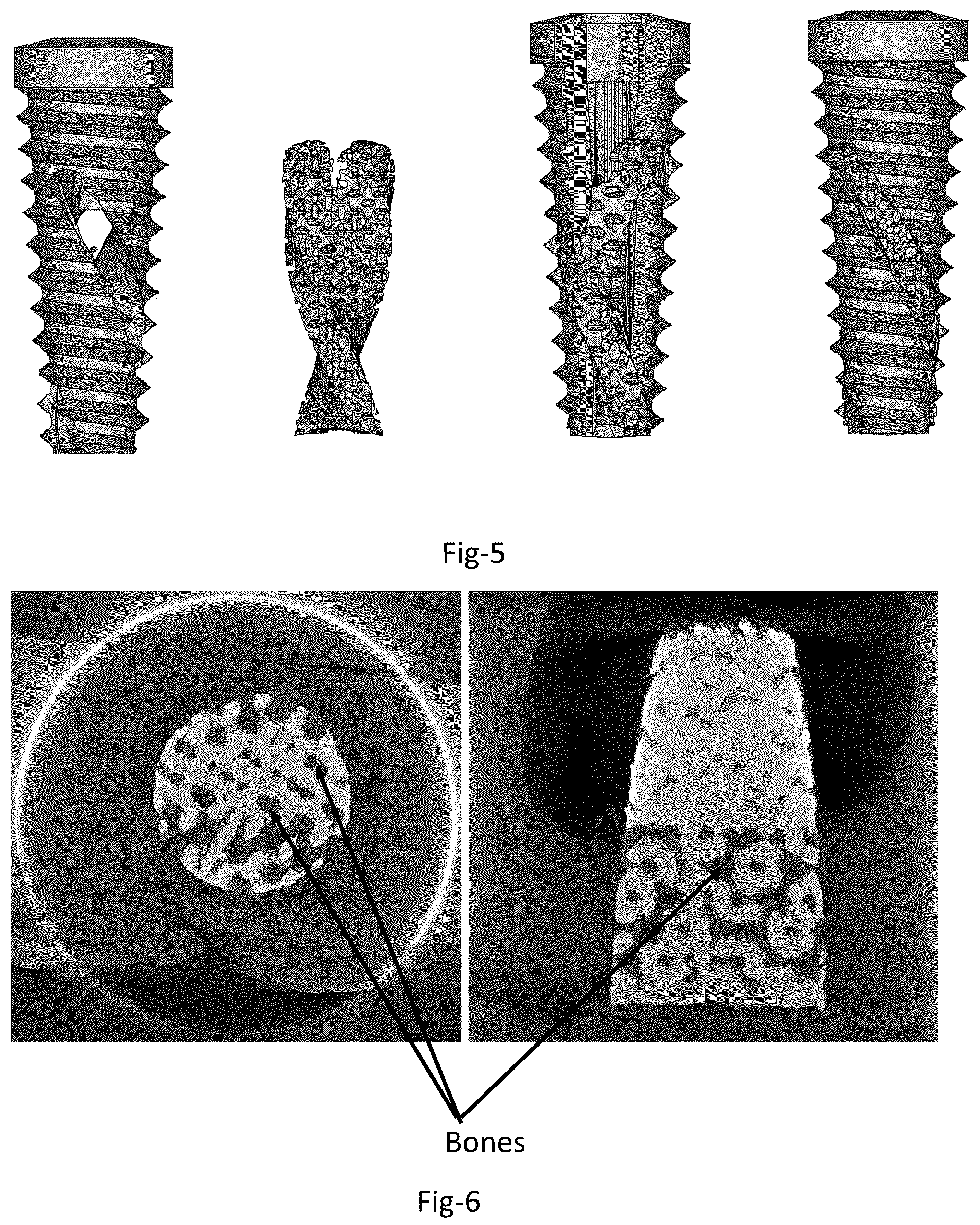 Patent US12310815 Figure 3 – Dental implant and self-locking fastening element with heterogeneousporous structures, and method for its production