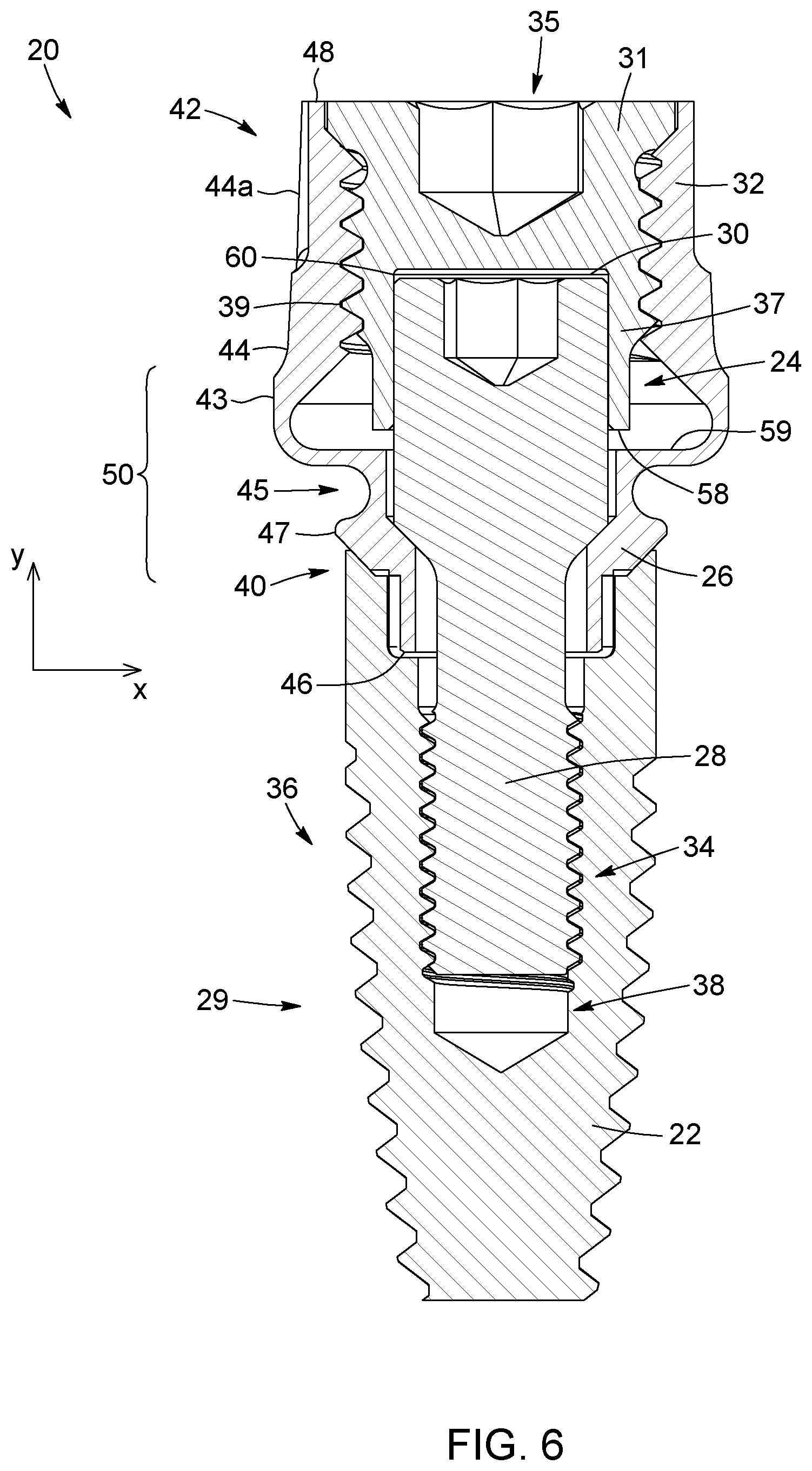 Patent US12310816 Figure 6 – Flexible abutment for use with dental implant