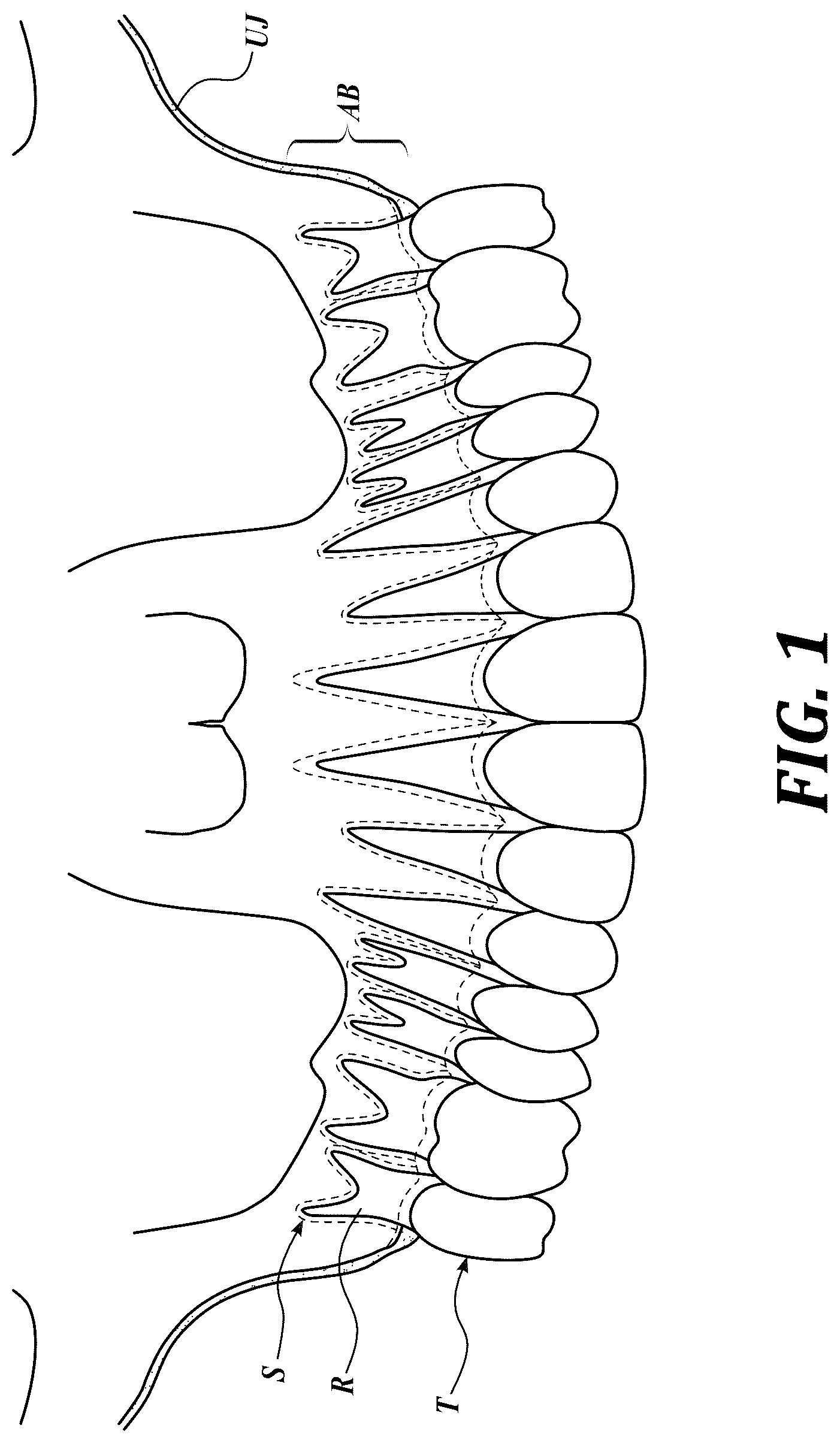 Patent US12310818 Figure 1 – Process for preparing a patient's jaw for a full arch teeth replacement