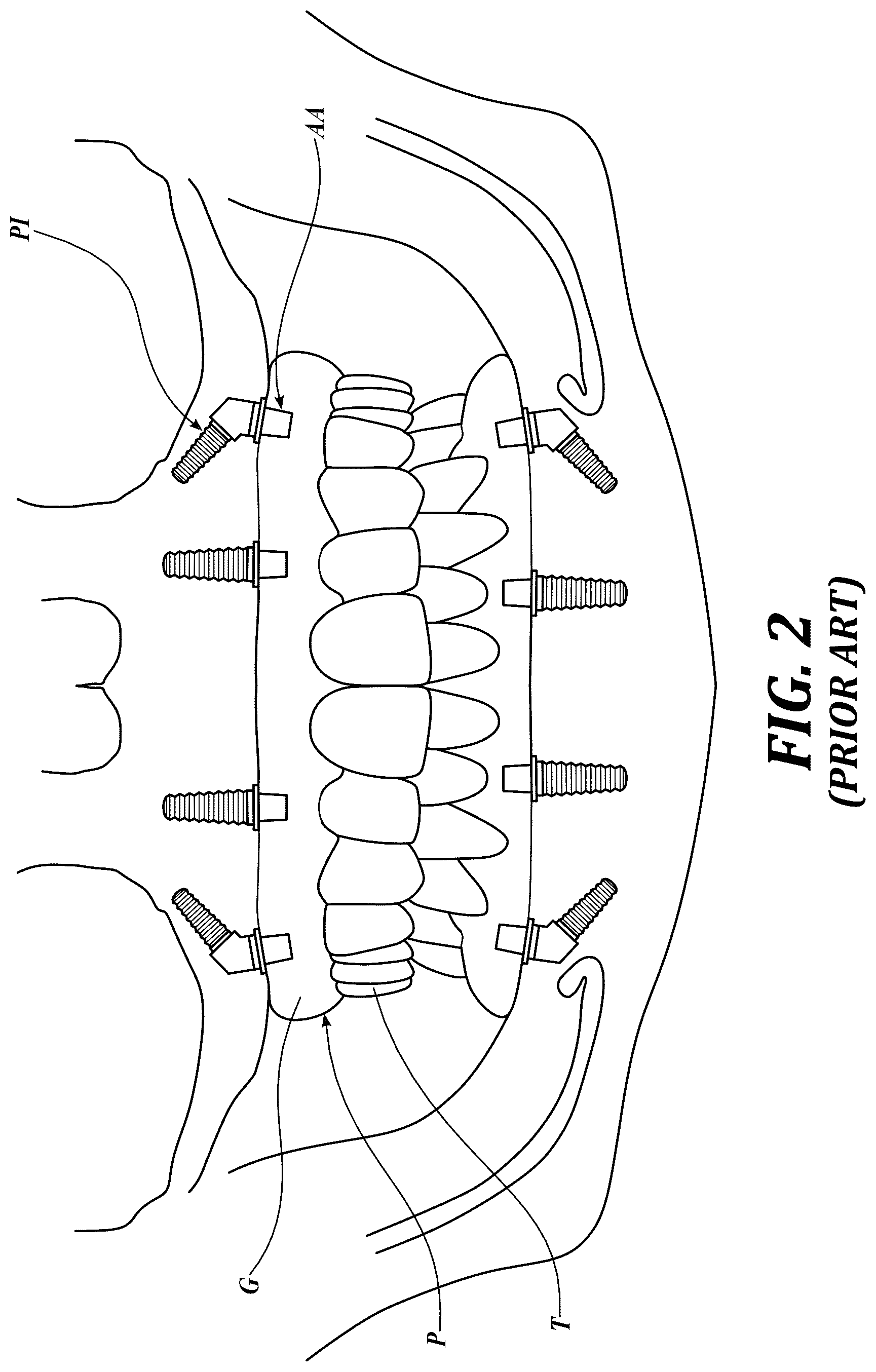 Patent US12310818 Figure 2 – Process for preparing a patient's jaw for a full arch teeth replacement