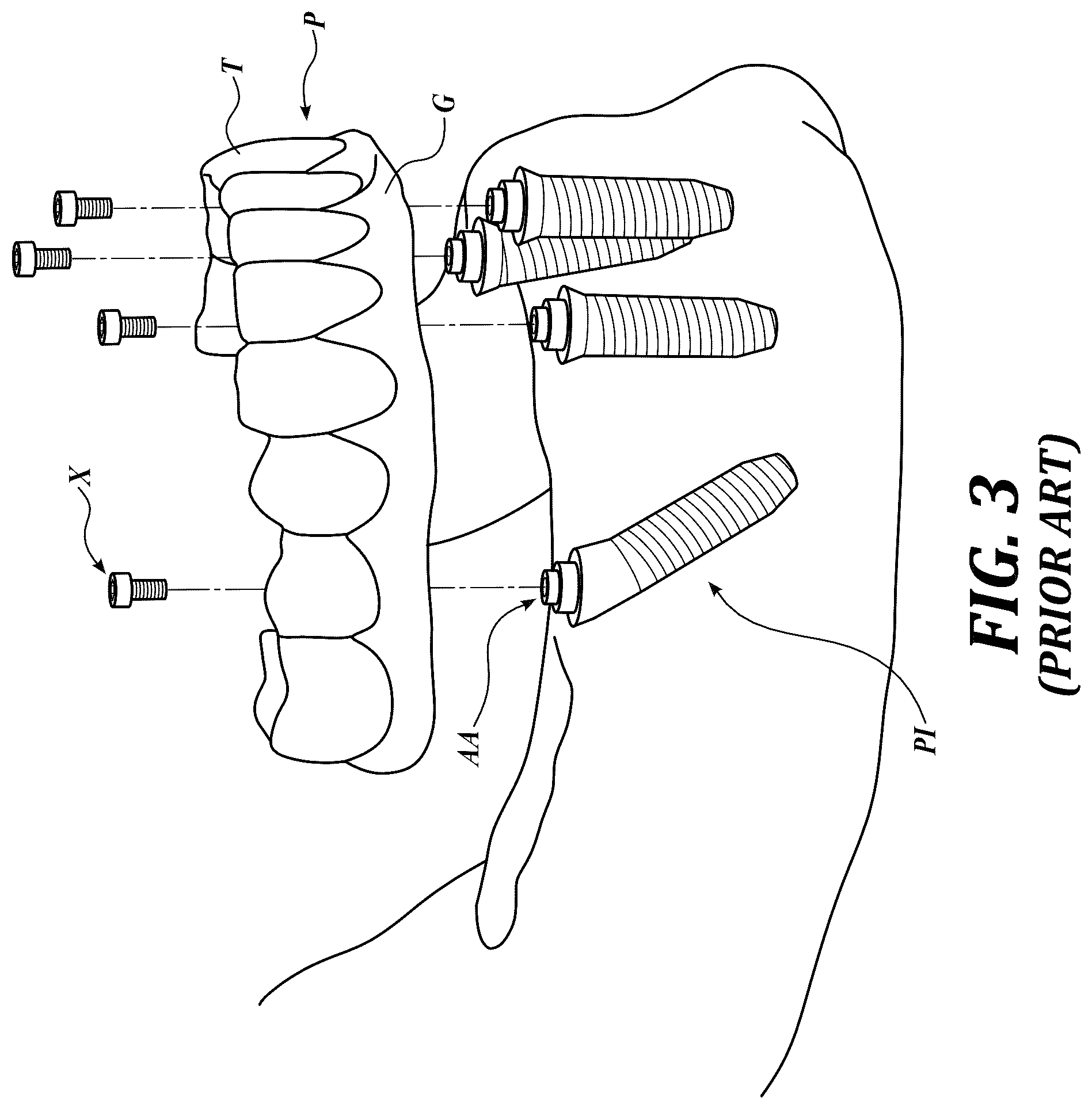 Patent US12310818 Figure 3 – Process for preparing a patient's jaw for a full arch teeth replacement