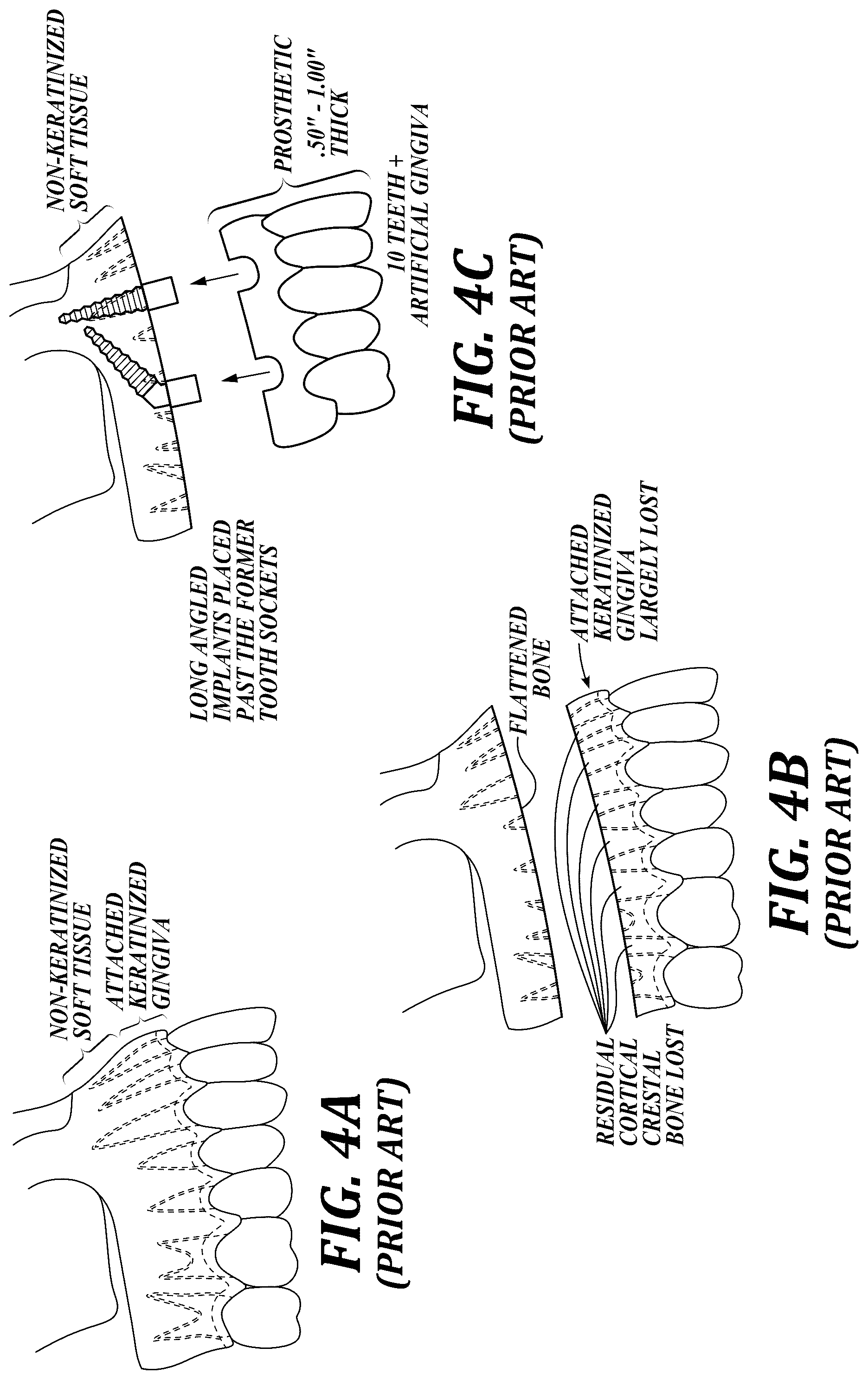 Patent US12310818 Figure 4 – Process for preparing a patient's jaw for a full arch teeth replacement