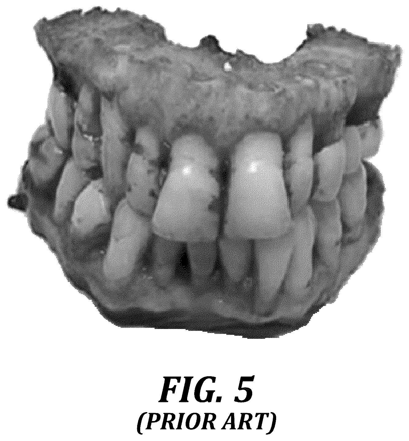 Patent US12310818 Figure 5 – Process for preparing a patient's jaw for a full arch teeth replacement