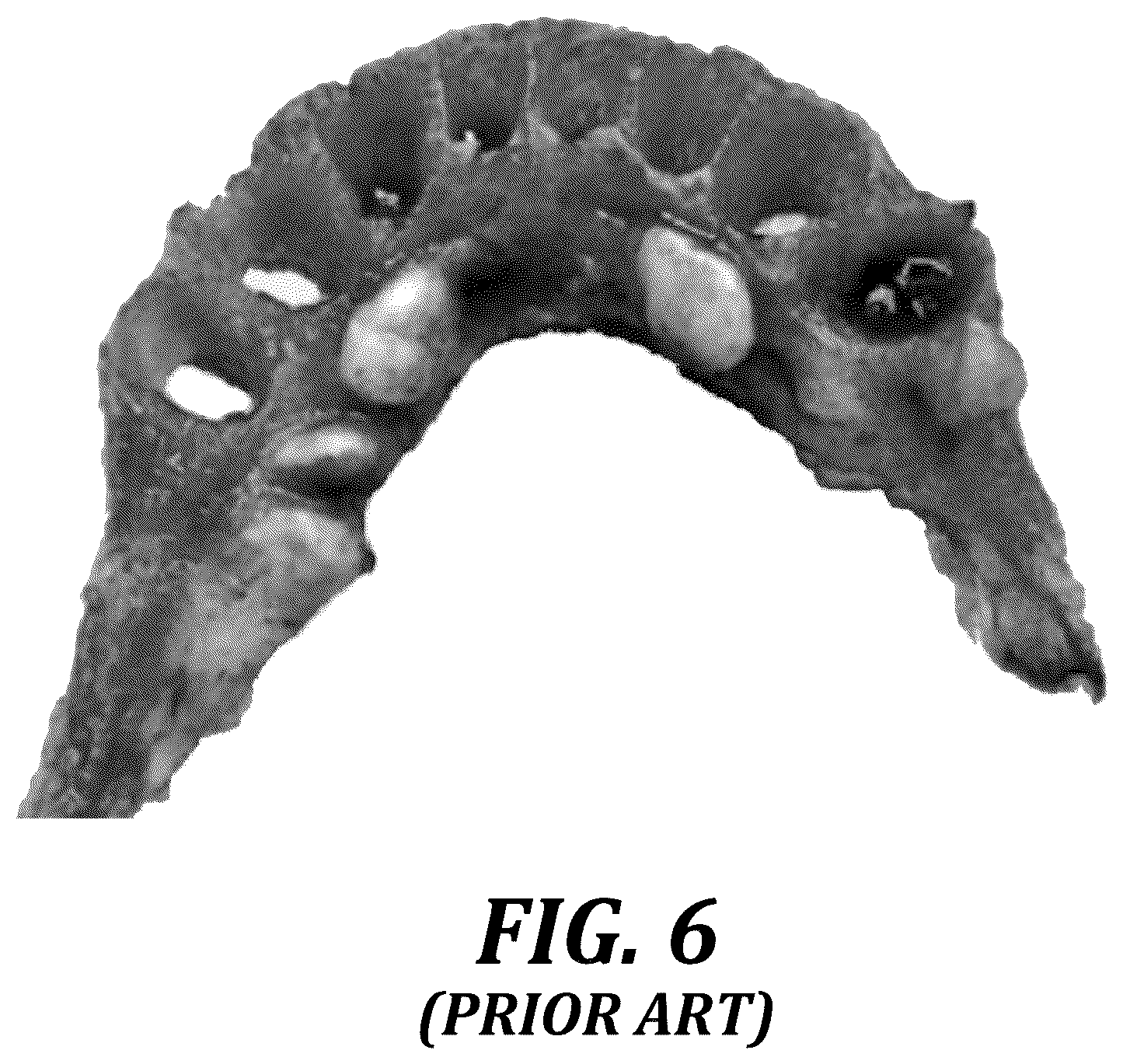 Patent US12310818 Figure 6 – Process for preparing a patient's jaw for a full arch teeth replacement