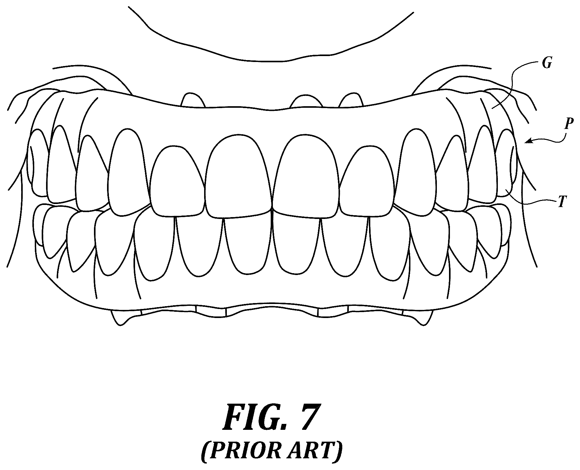 Patent US12310818 Figure 7 – Process for preparing a patient's jaw for a full arch teeth replacement