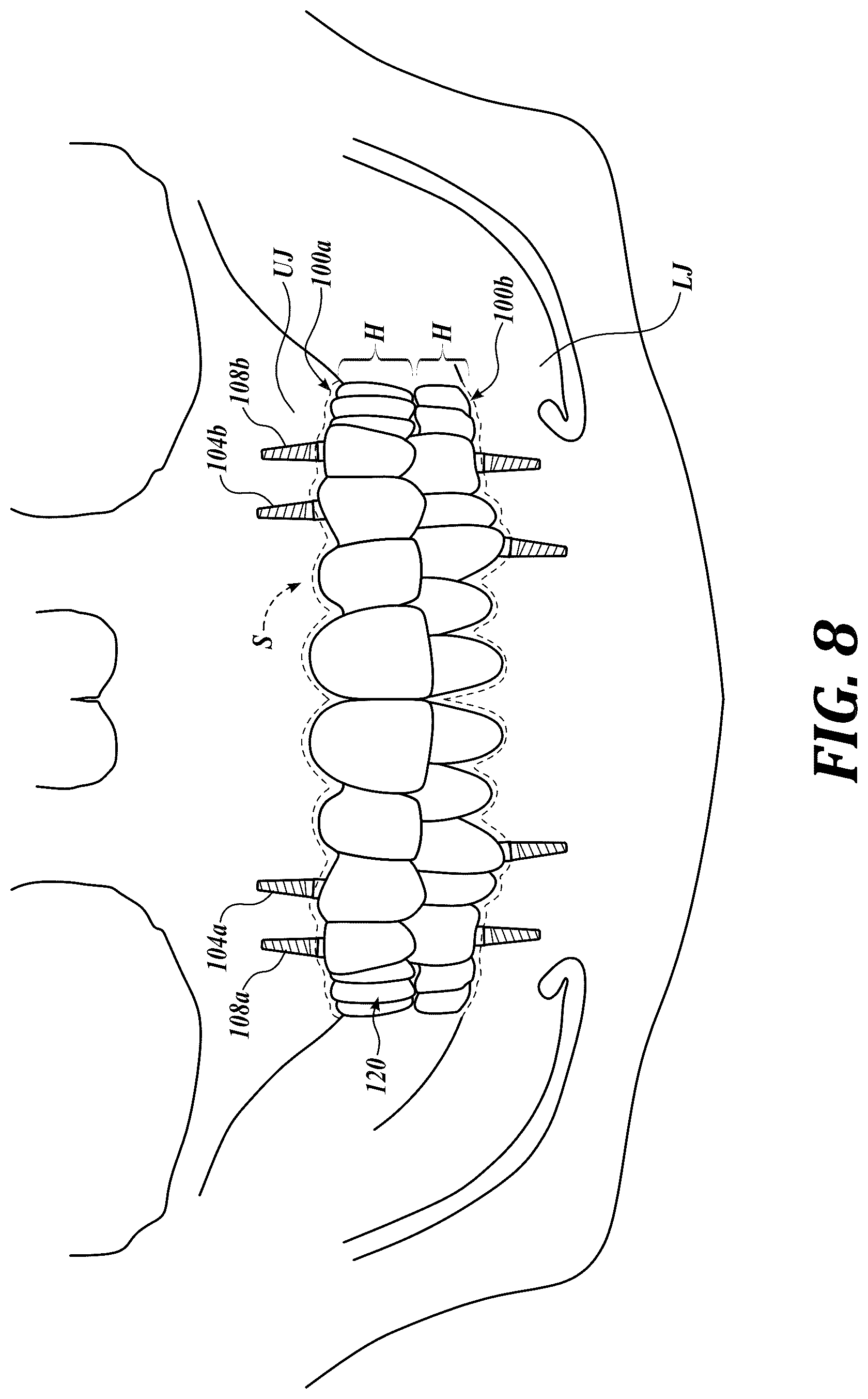 Patent US12310818 Figure 8 – Process for preparing a patient's jaw for a full arch teeth replacement