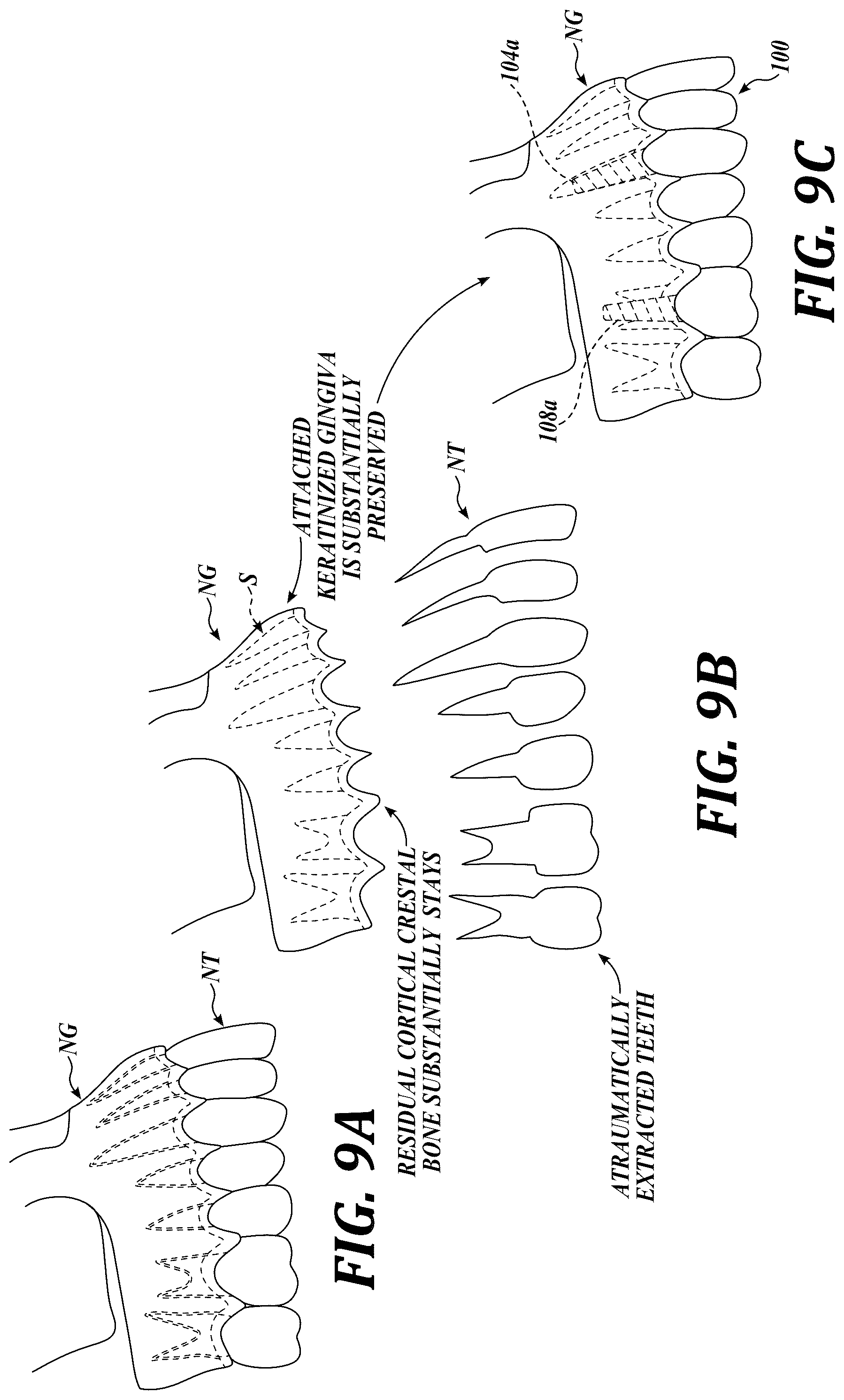 Patent US12310818 Figure 9 – Process for preparing a patient's jaw for a full arch teeth replacement