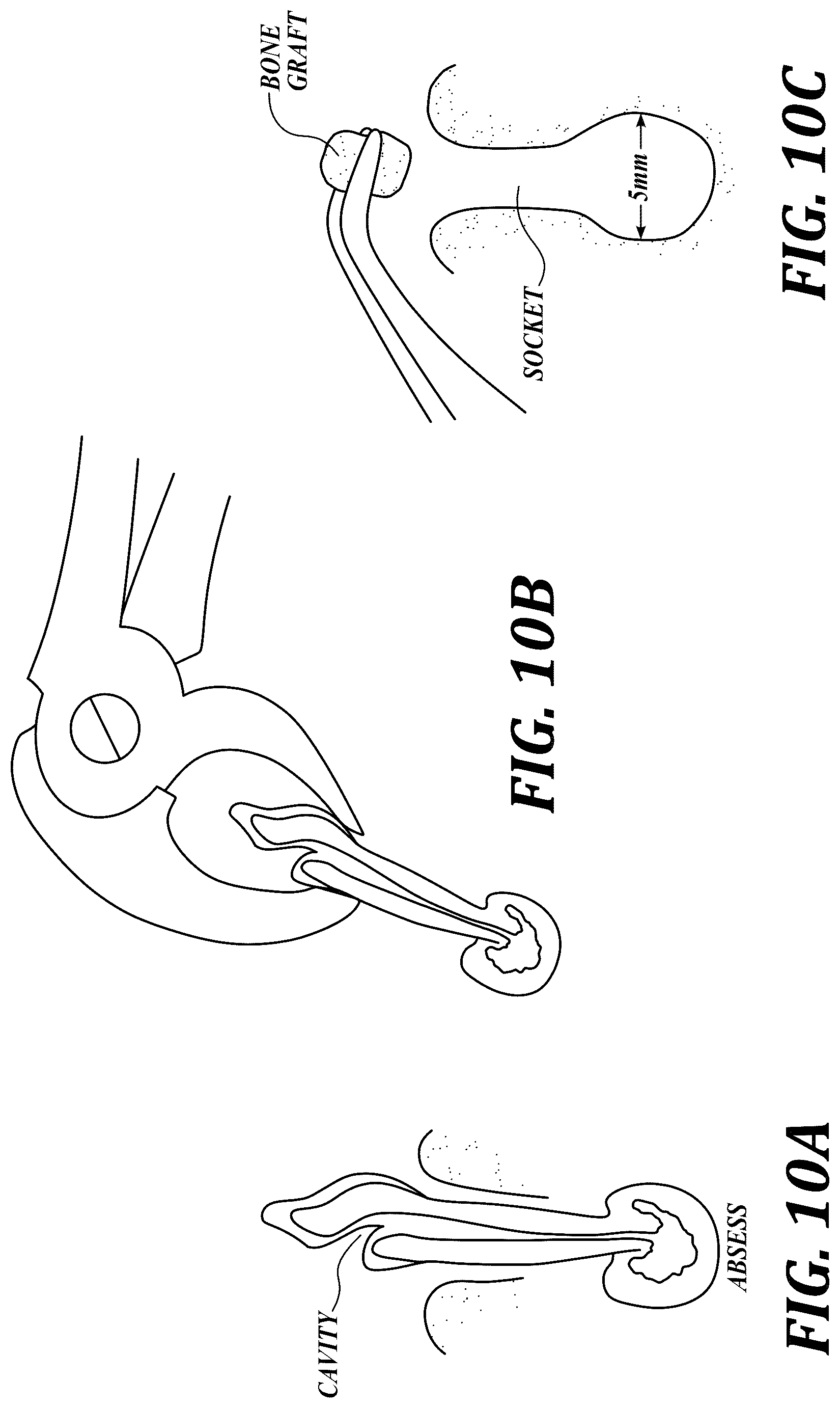 Patent US12310818 Figure 10 – Process for preparing a patient's jaw for a full arch teeth replacement