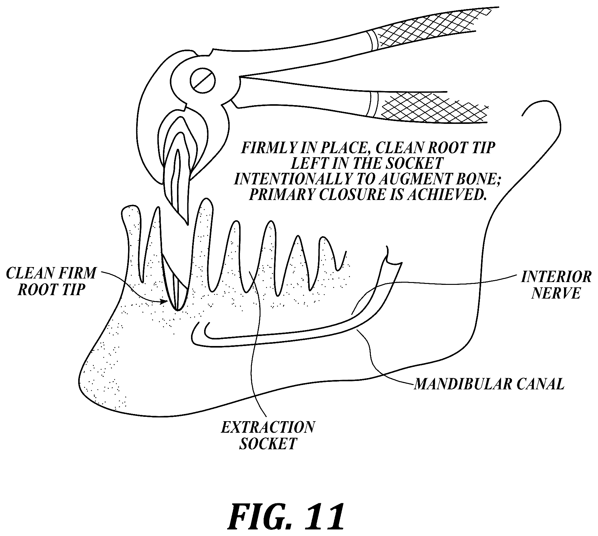 Patent US12310818 Figure 11 – Process for preparing a patient's jaw for a full arch teeth replacement