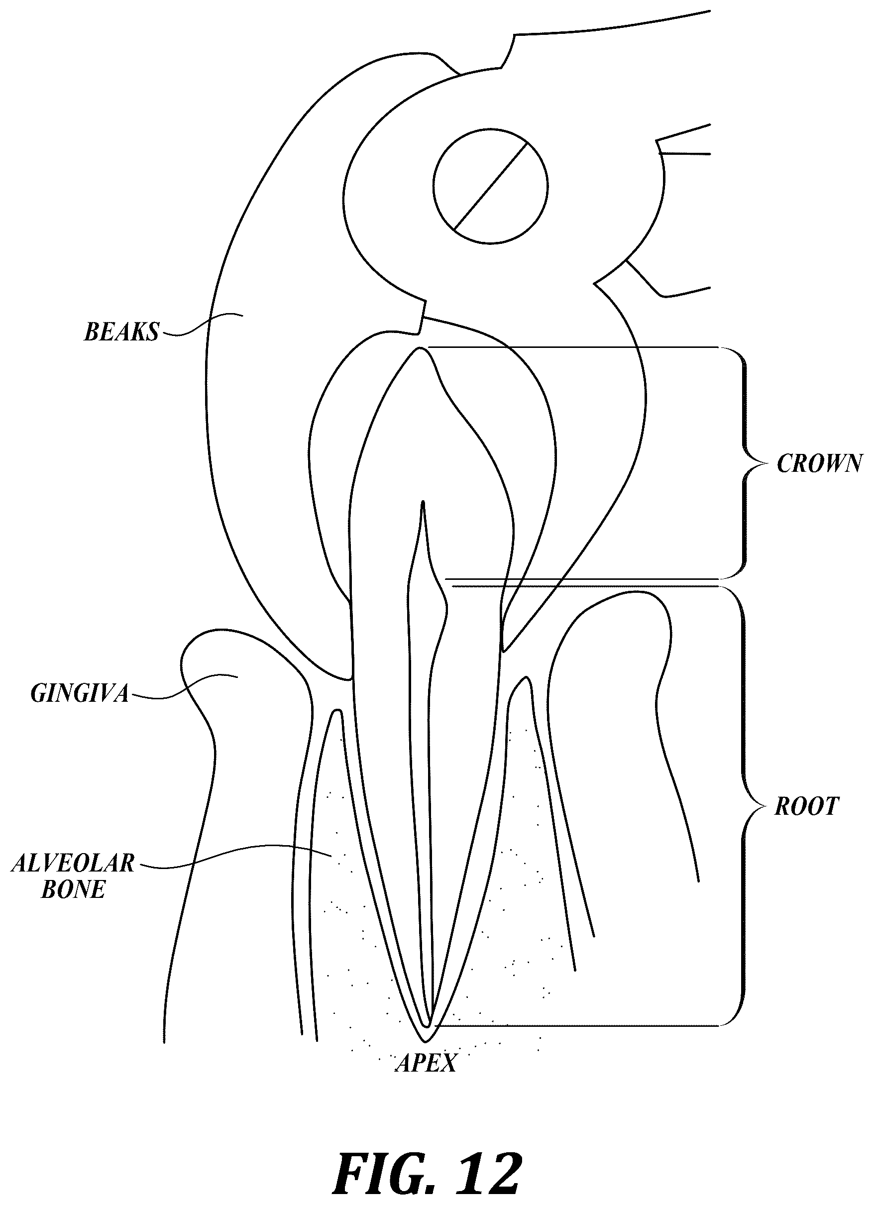 Patent US12310818 Figure 12 – Process for preparing a patient's jaw for a full arch teeth replacement