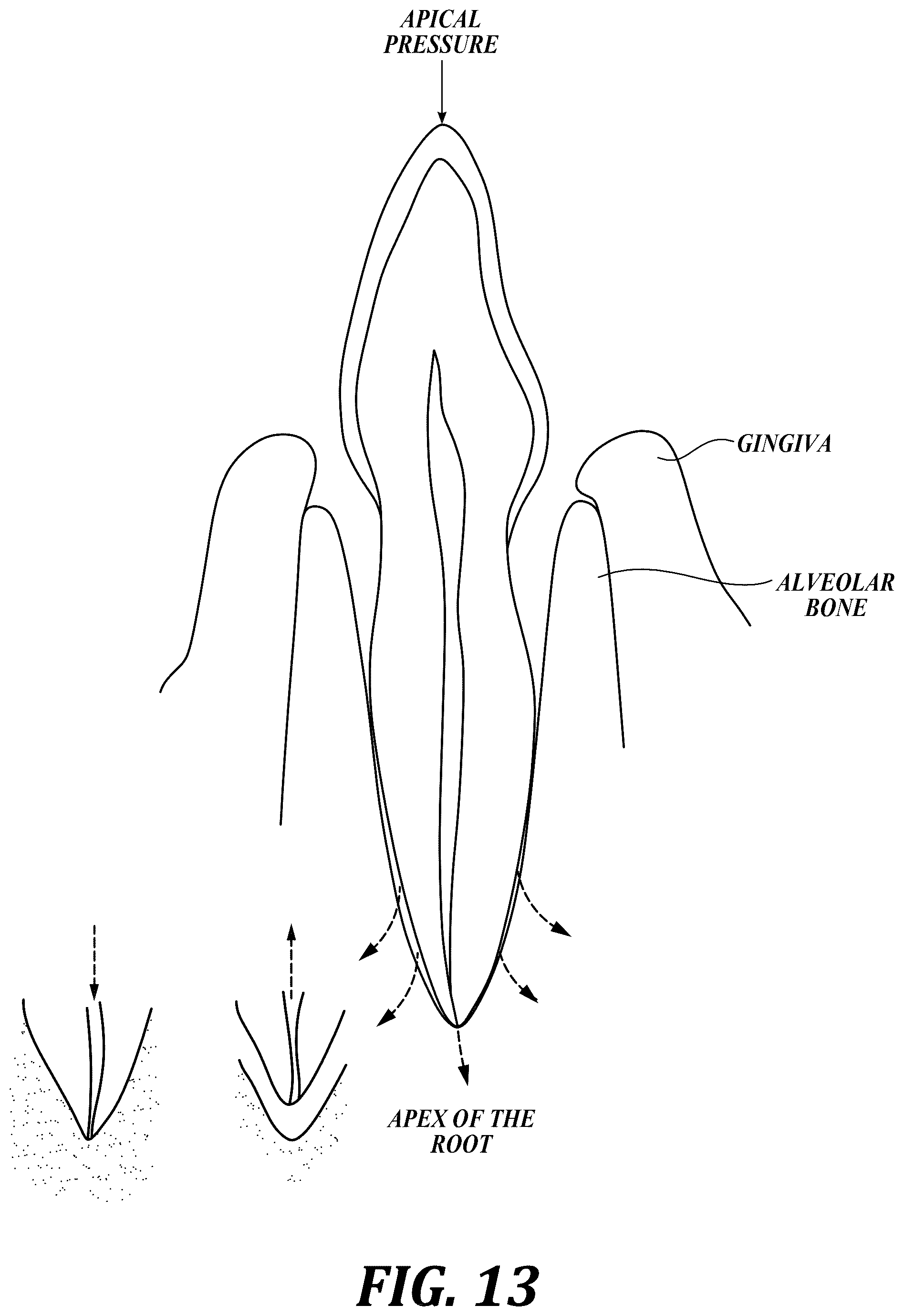 Patent US12310818 Figure 13 – Process for preparing a patient's jaw for a full arch teeth replacement