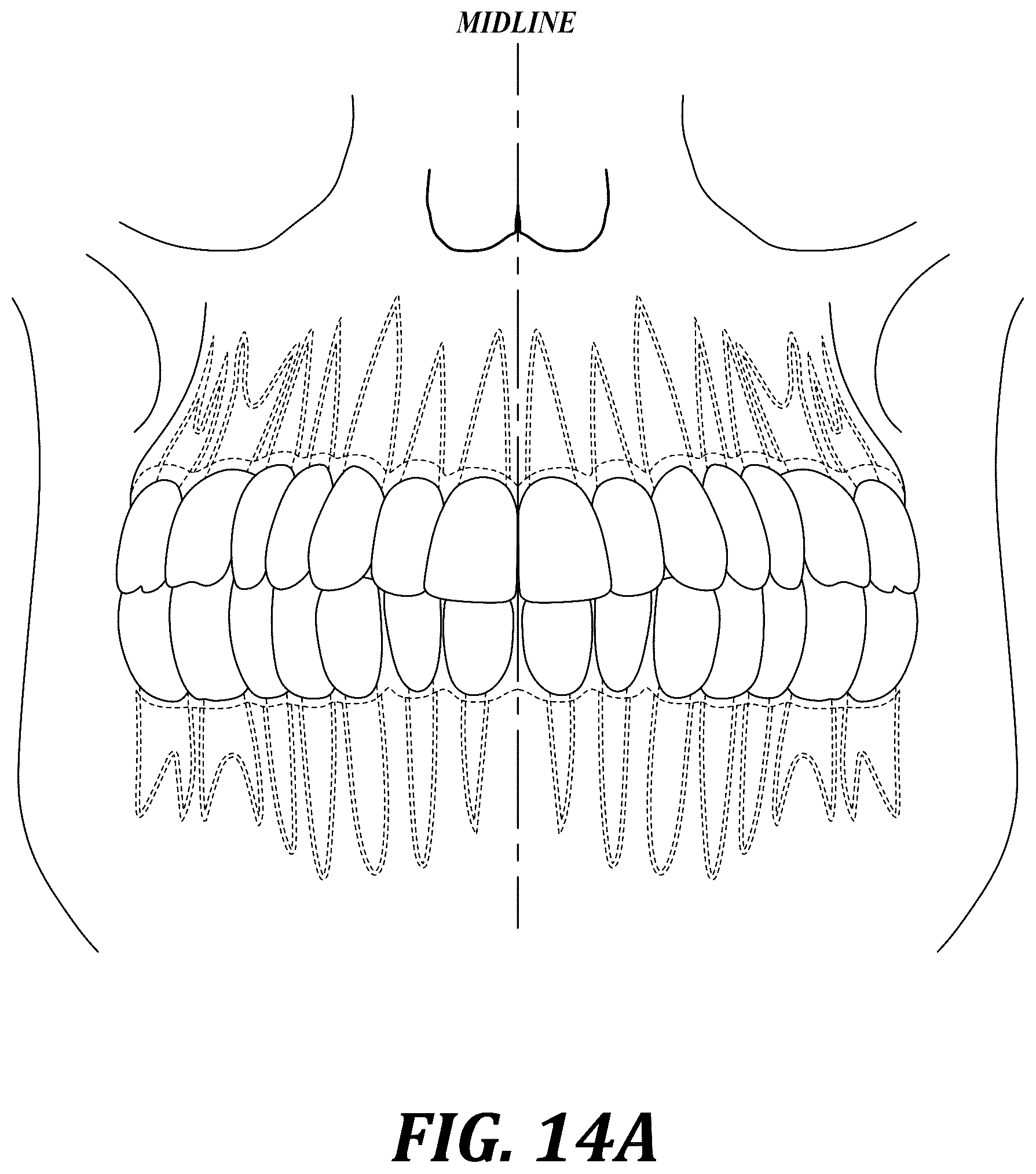 Patent US12310818 Figure 14 – Process for preparing a patient's jaw for a full arch teeth replacement