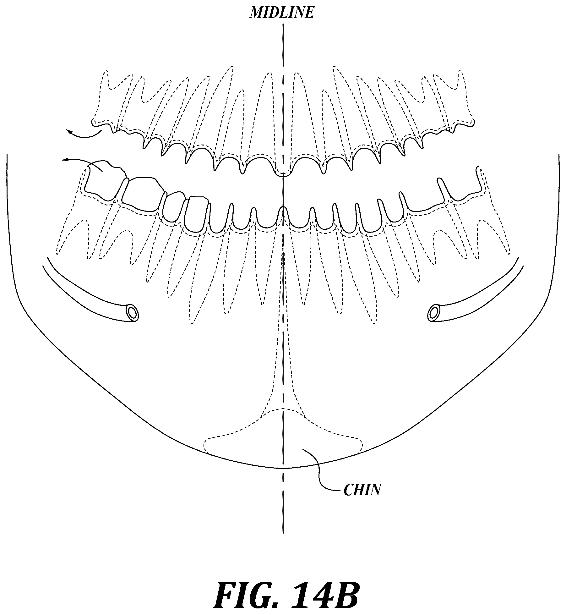 Patent US12310818 Figure 15 – Process for preparing a patient's jaw for a full arch teeth replacement