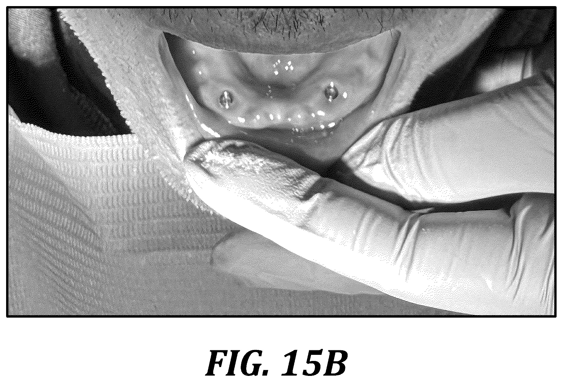 Patent US12310818 Figure 17 – Process for preparing a patient's jaw for a full arch teeth replacement
