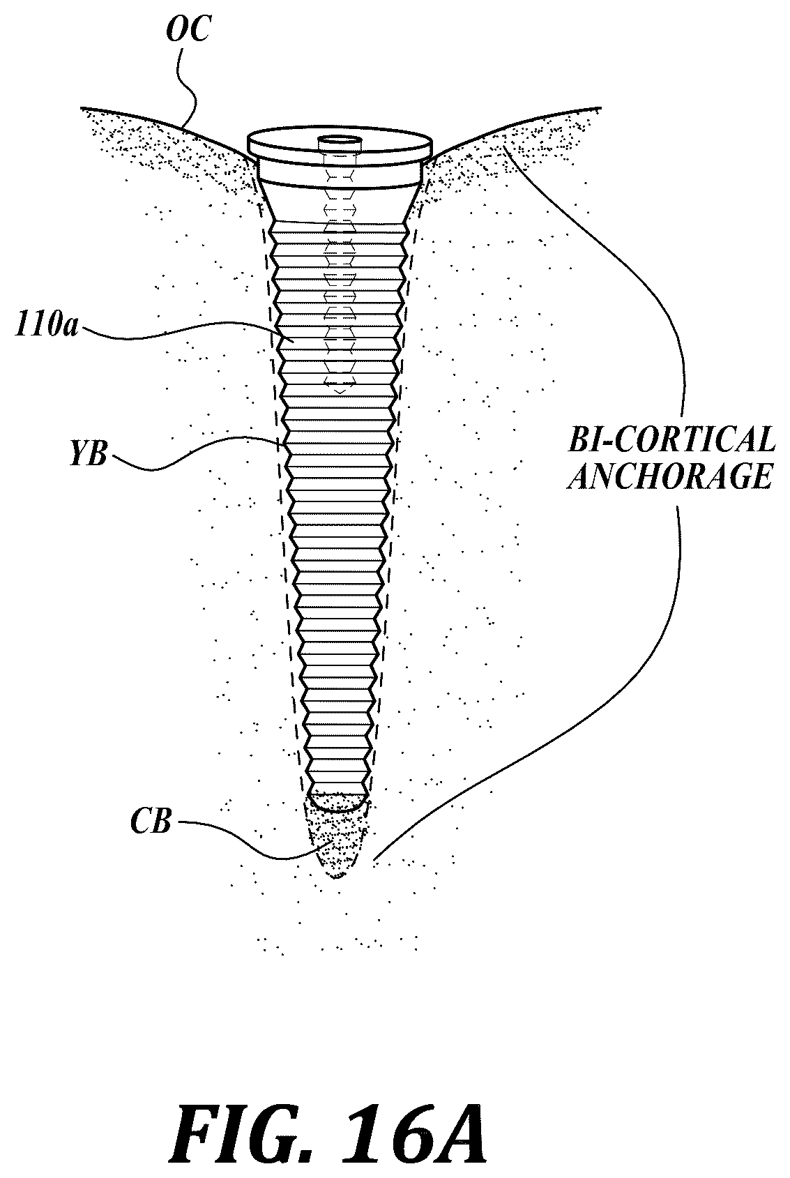 Patent US12310818 Figure 18 – Process for preparing a patient's jaw for a full arch teeth replacement