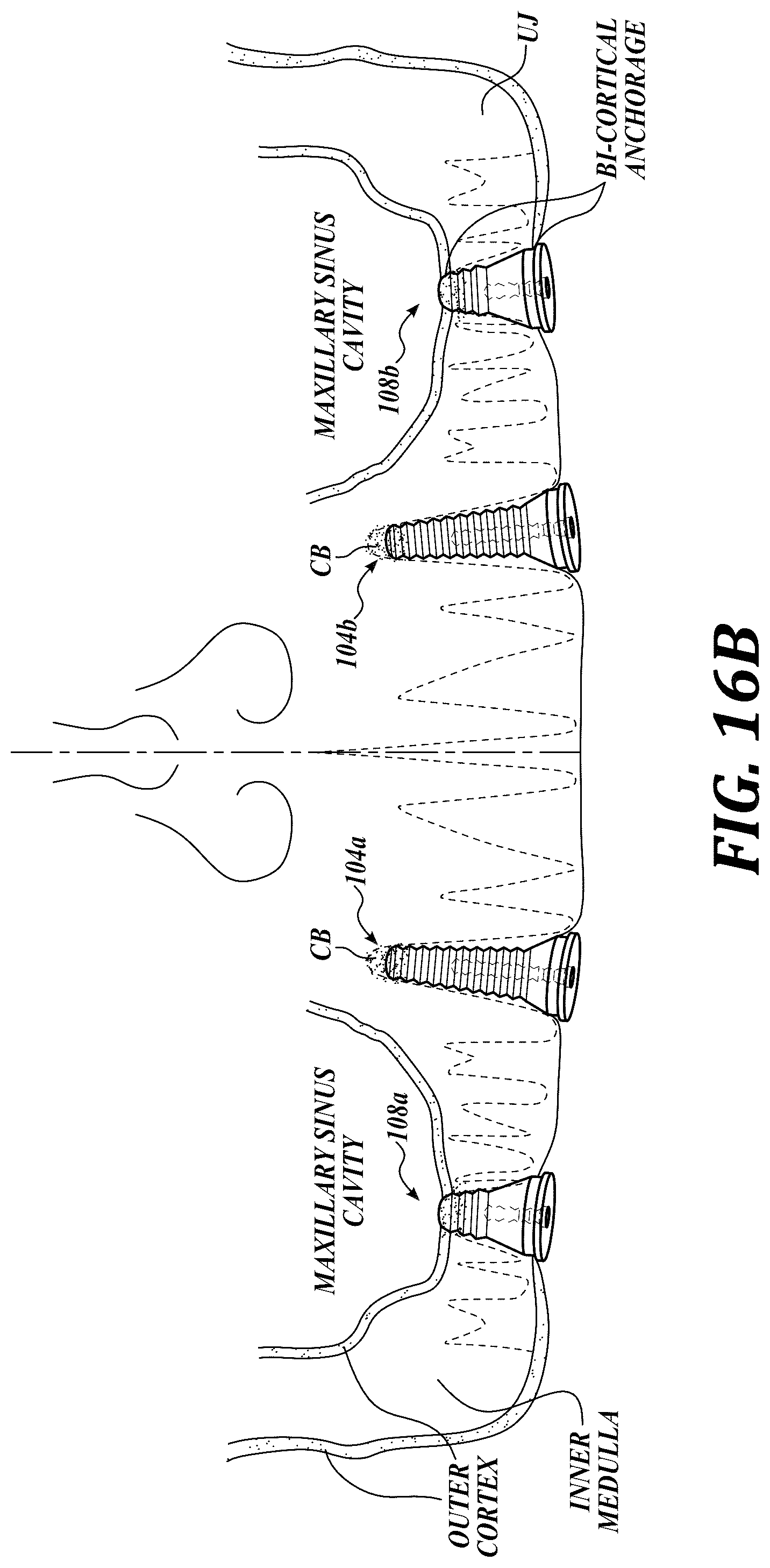 Patent US12310818 Figure 19 – Process for preparing a patient's jaw for a full arch teeth replacement