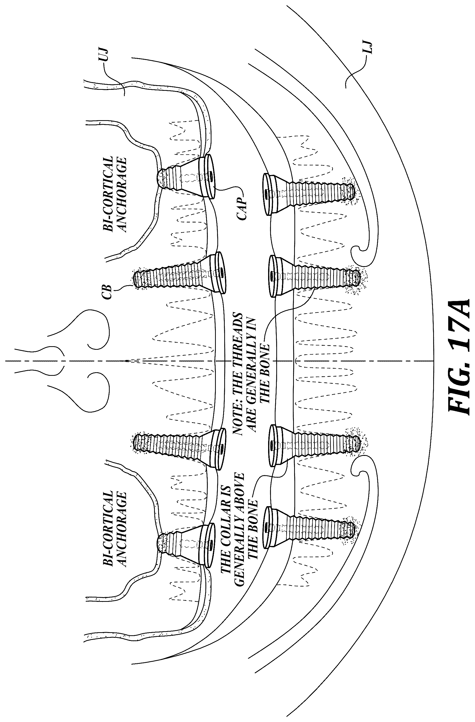 Patent US12310818 Figure 20 – Process for preparing a patient's jaw for a full arch teeth replacement