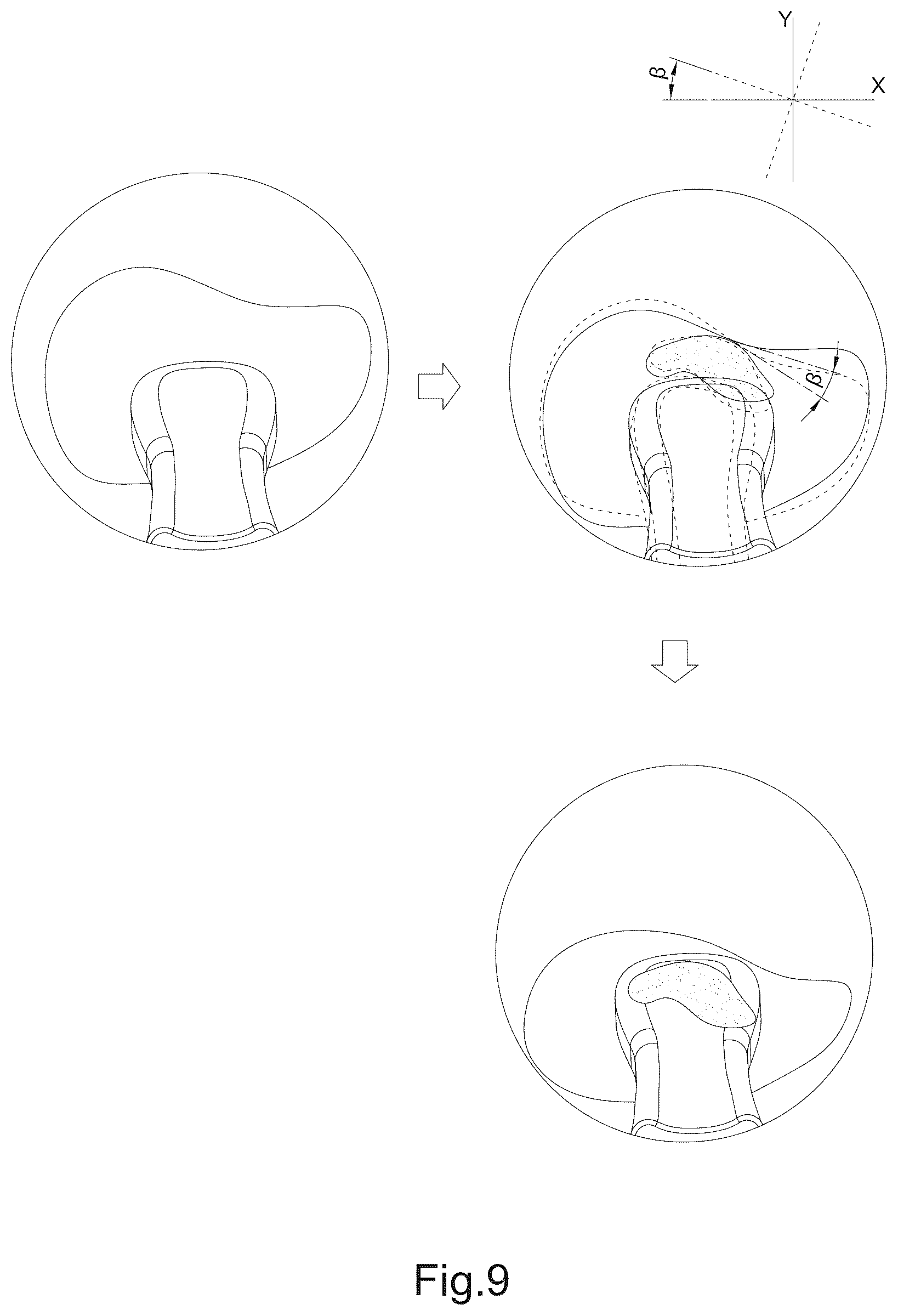 Patent US12310820 Figure 11 – Image processing method and operation interface for ear cleaning arrangement
