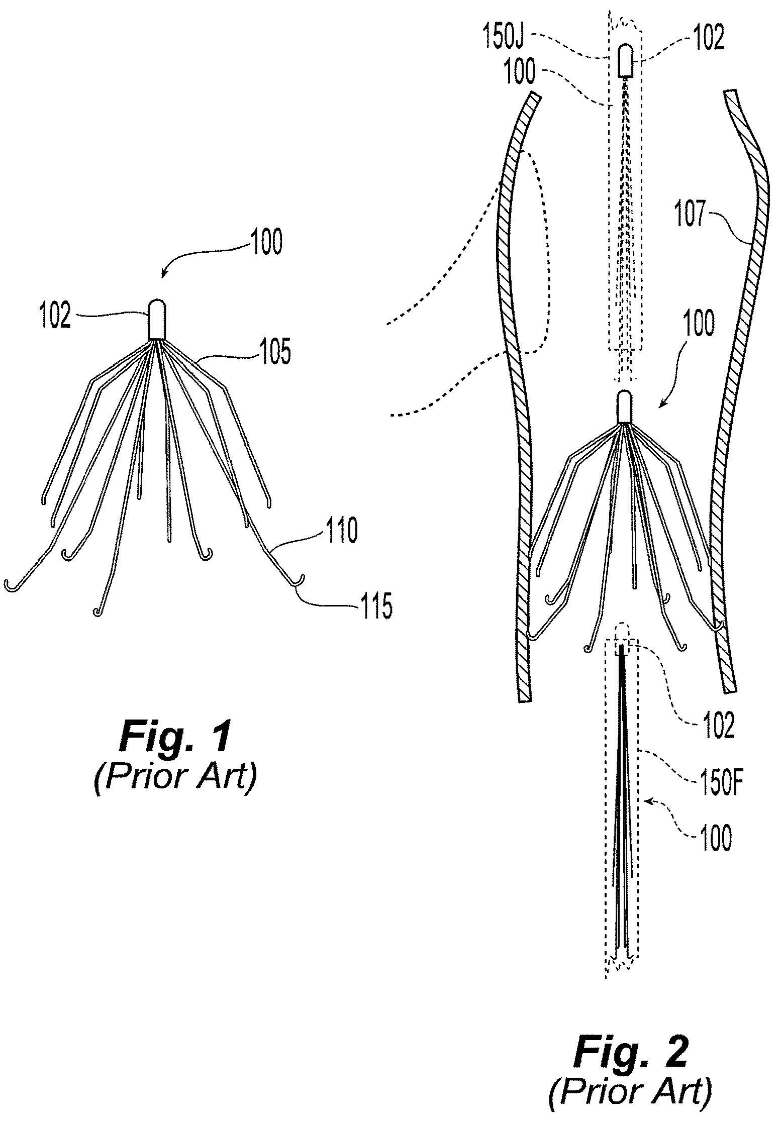Patent US12310831 Figure 1 – Jugular femoral vena cava filter system