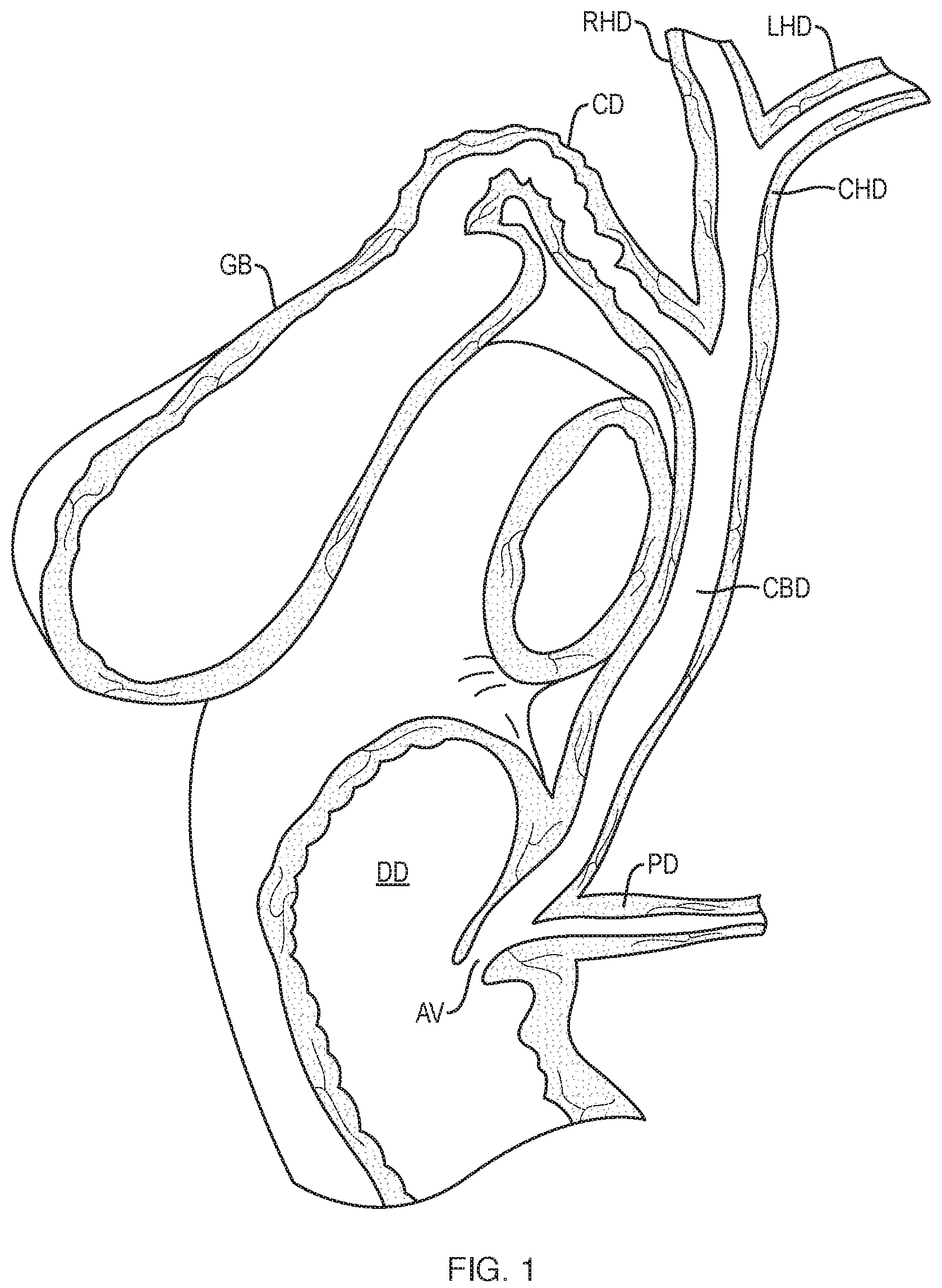 Patent US12310832 Figure 1 – Biliary stents and methods