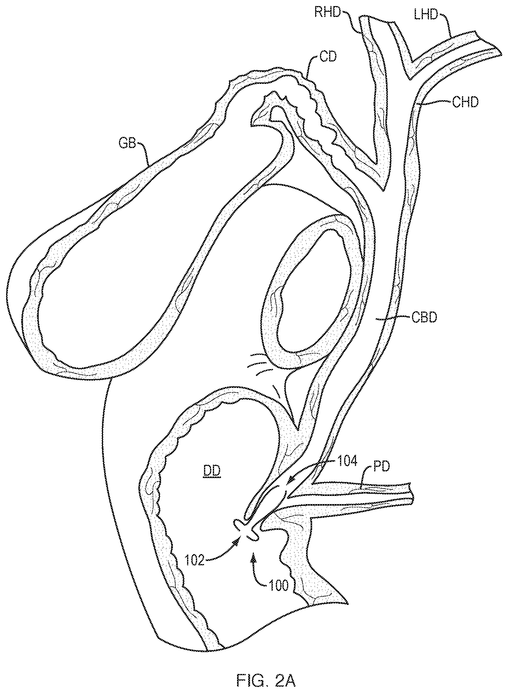 Patent US12310832 Figure 2 – Biliary stents and methods