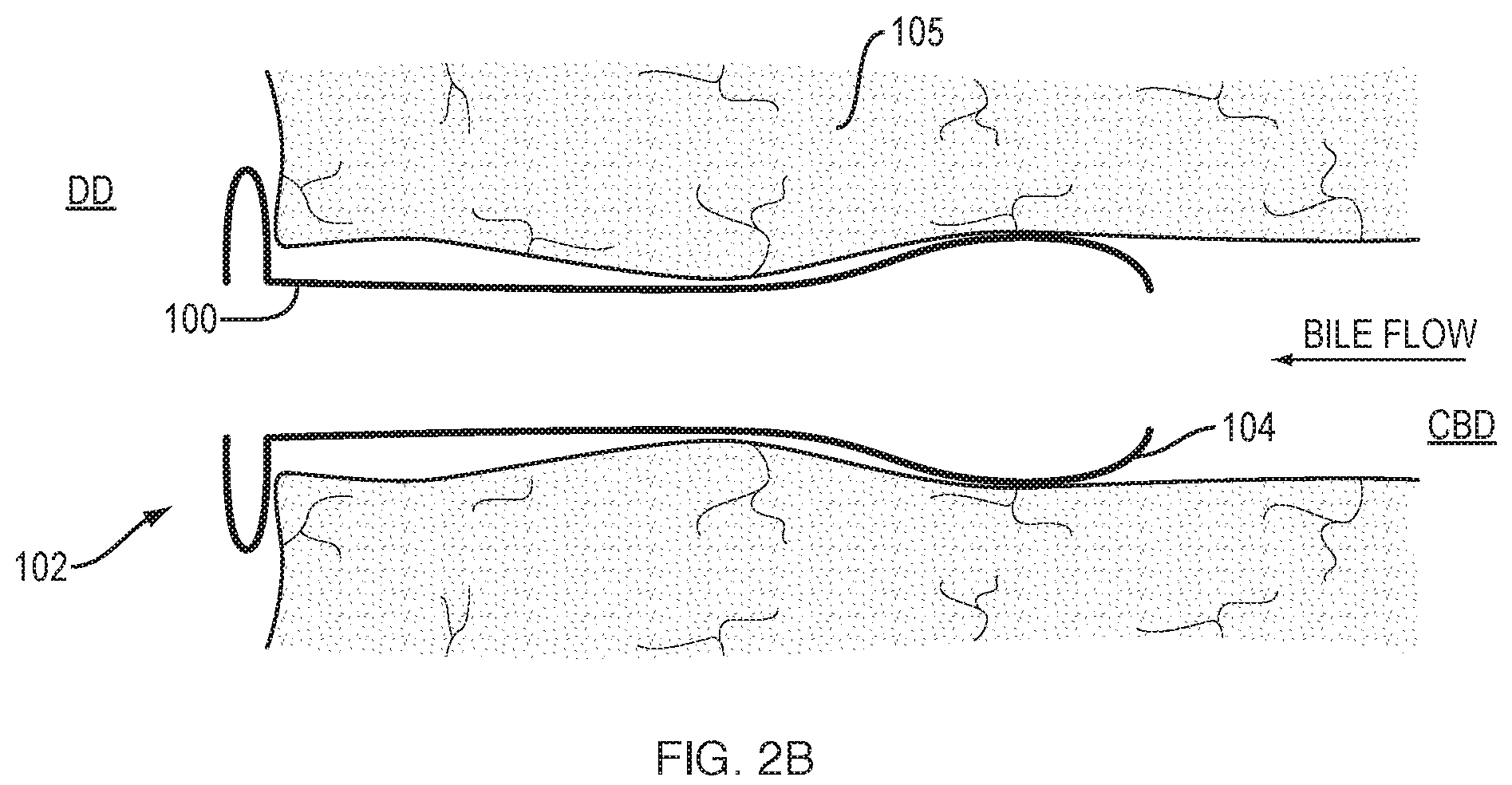 Patent US12310832 Figure 3 – Biliary stents and methods