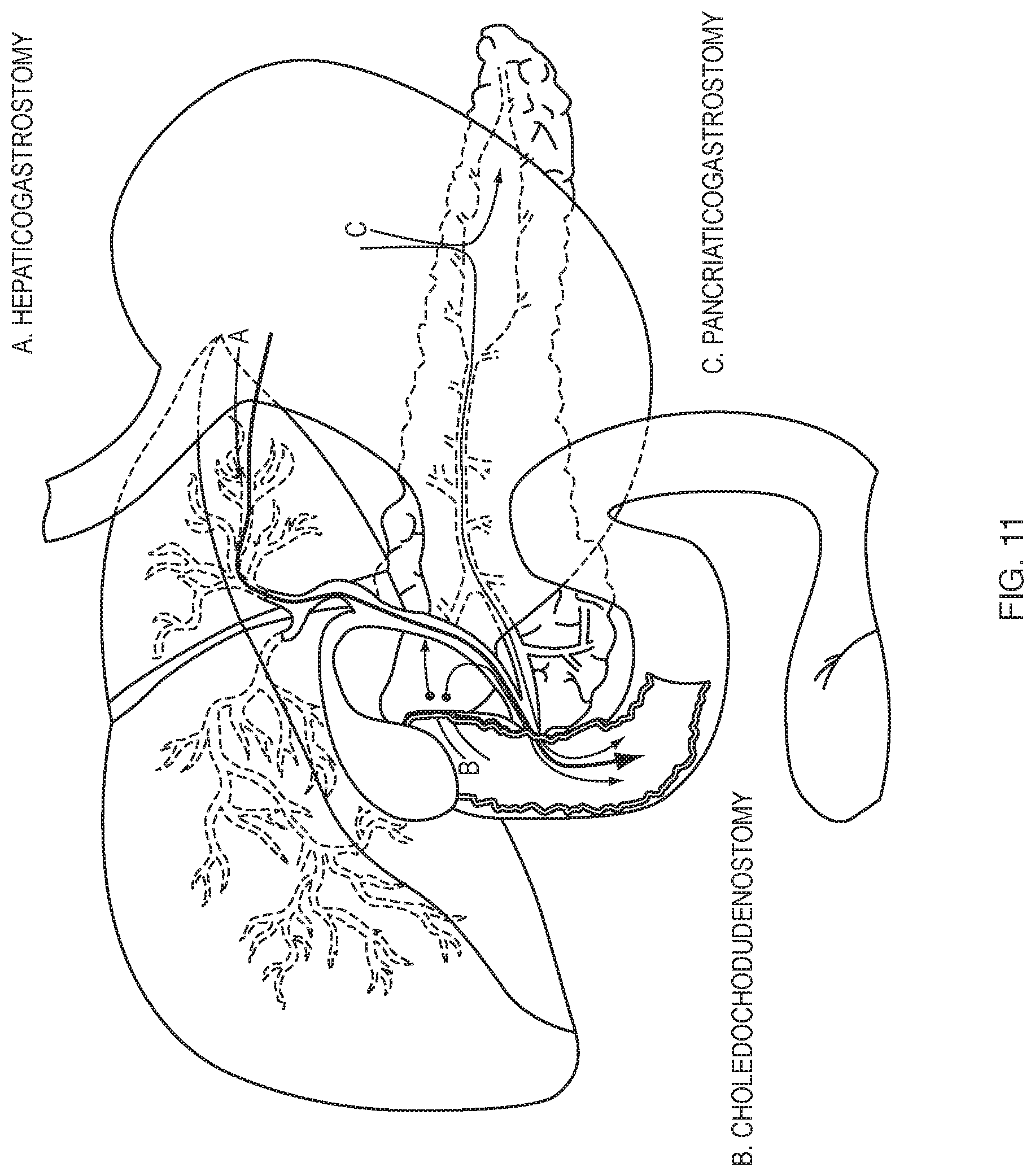 Patent US12310832 Figure 8 – Biliary stents and methods