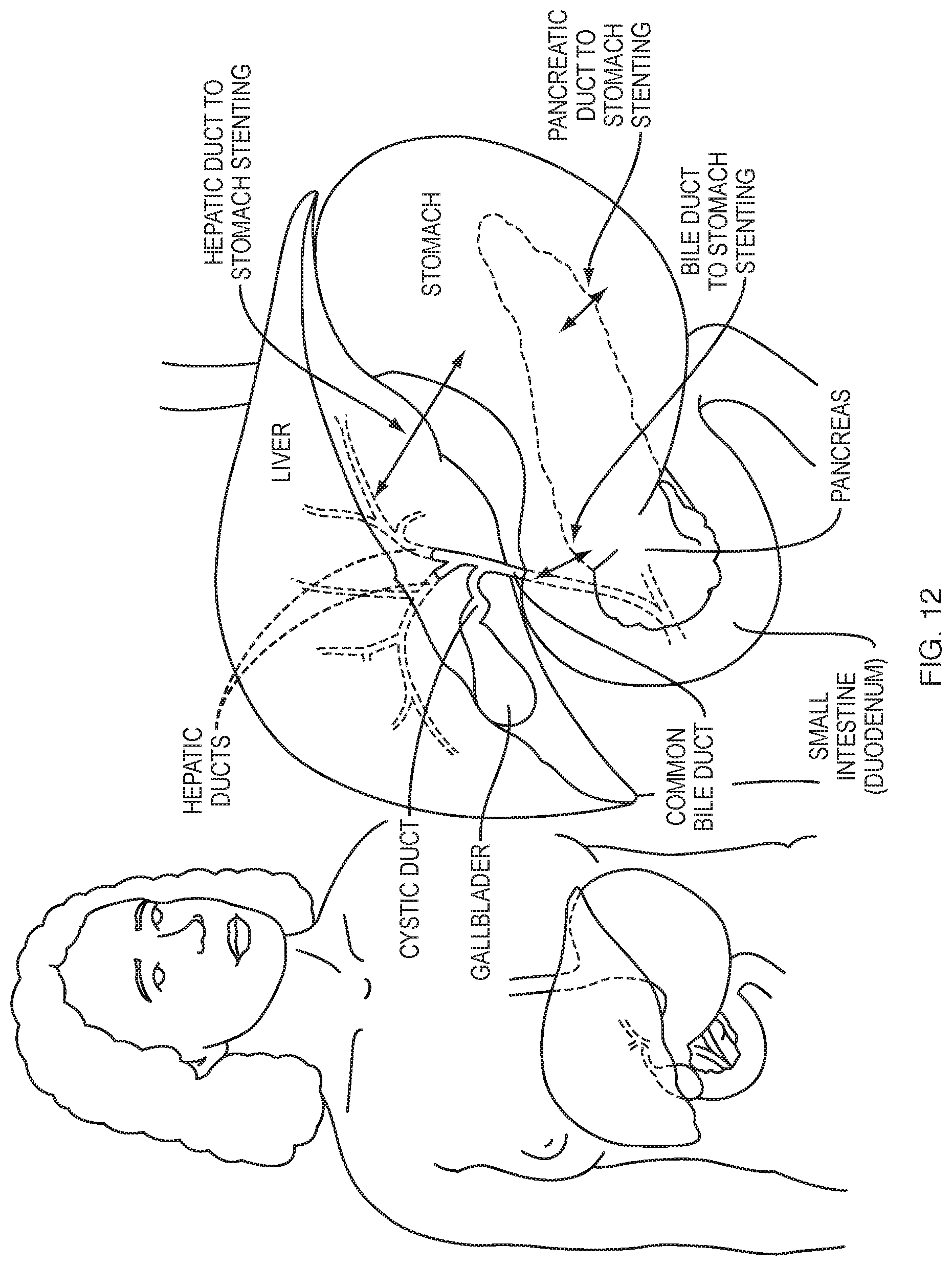 Patent US12310832 Figure 9 – Biliary stents and methods