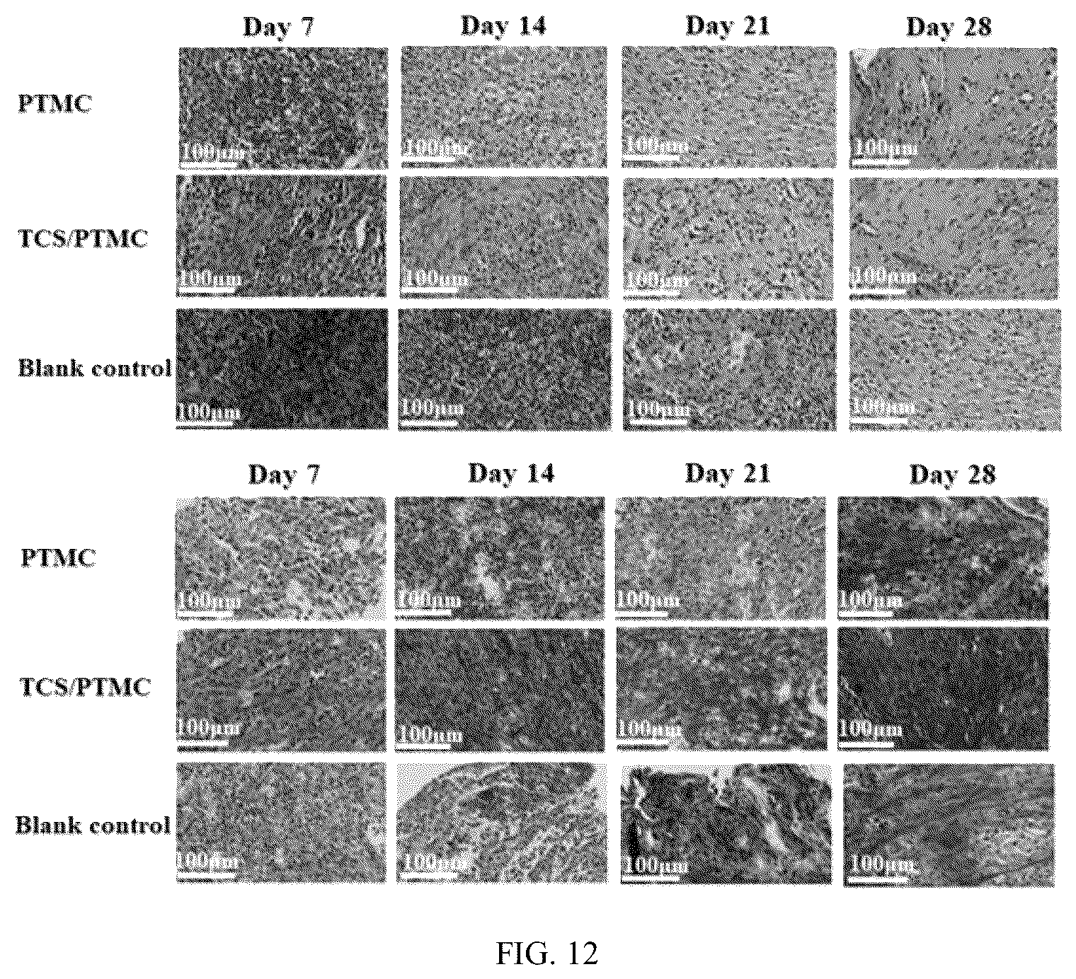 Patent US12310834 Figure 6 – PTMC-based intestinal anastomosis stent of bioabsorbable flexible elastomer and preparation method therefor