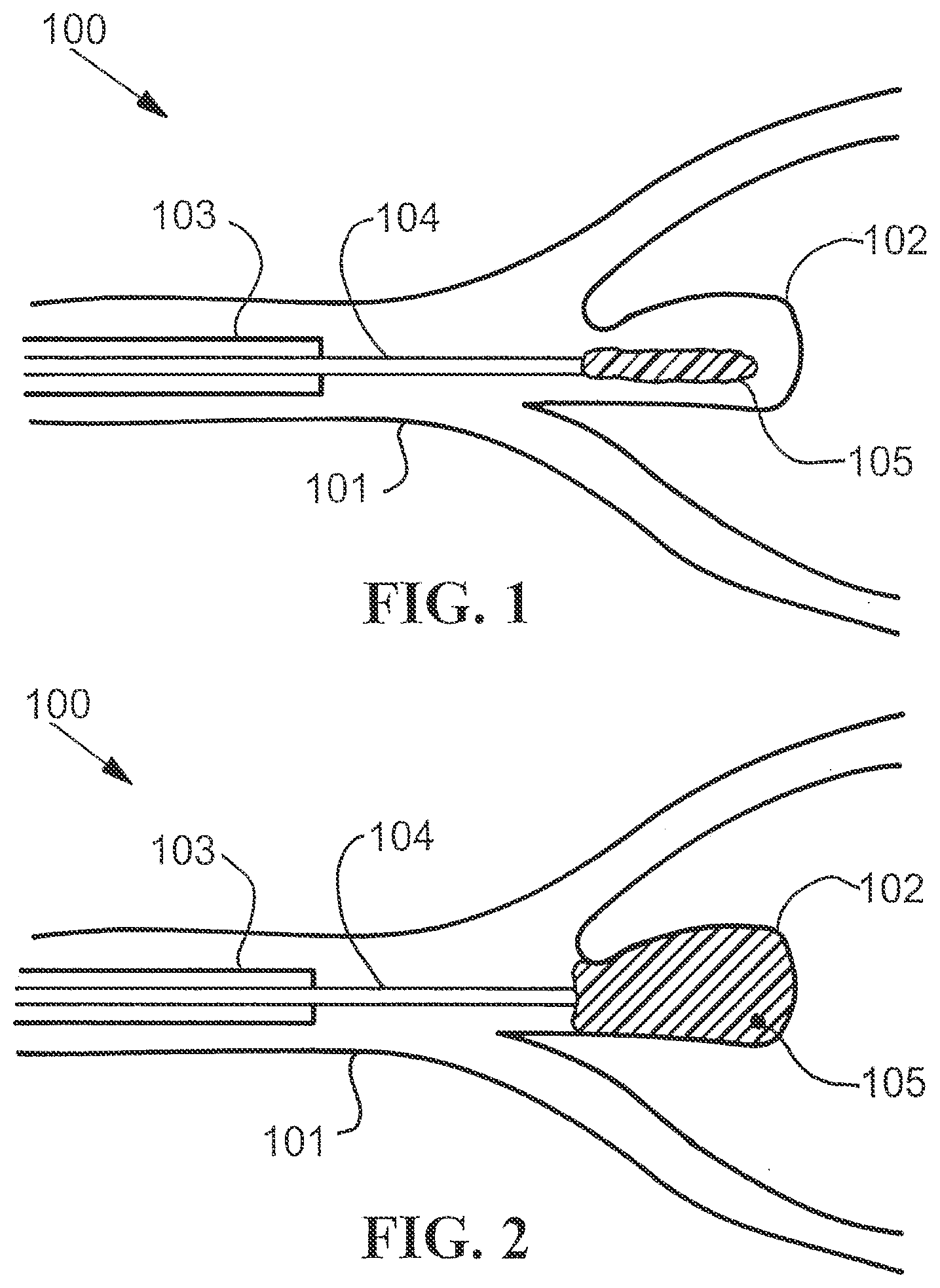 Patent US12310835 Figure 1 – Stent with expandable foam