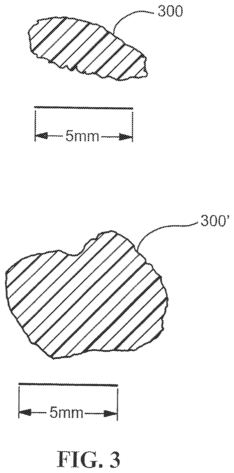 Patent US12310835 Figure 2 – Stent with expandable foam