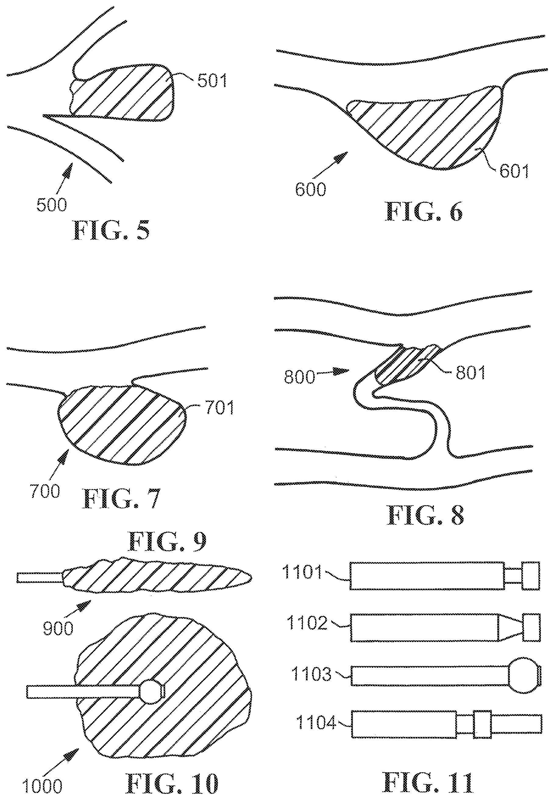 Patent US12310835 Figure 4 – Stent with expandable foam